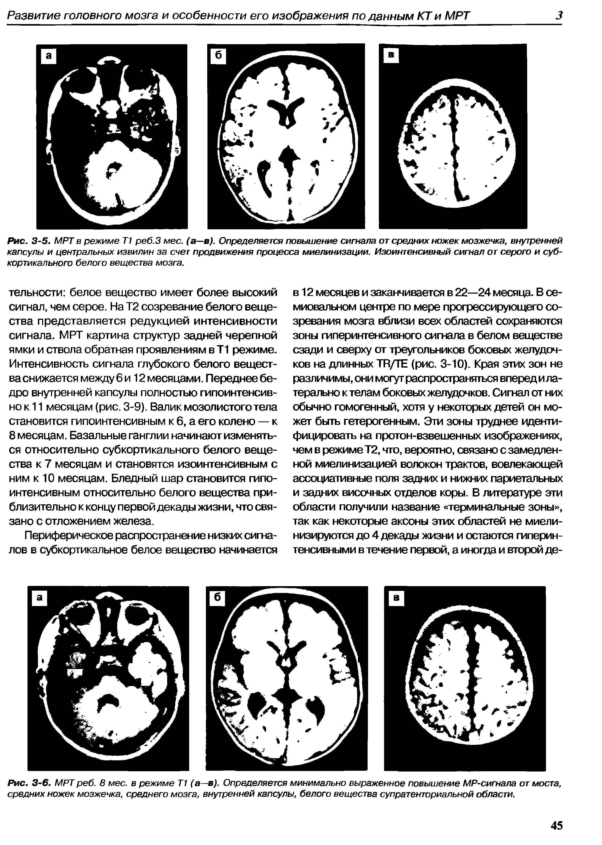 Рис. 3-6. МРТ реб. 8 мес. в режиме Т1 (а—в). Определяется минимально выраженное повышение MP-сигнала от моста, средних ножек мозжечка, среднего мозга, внутренней капсулы, белого вещества супратенториальной области.