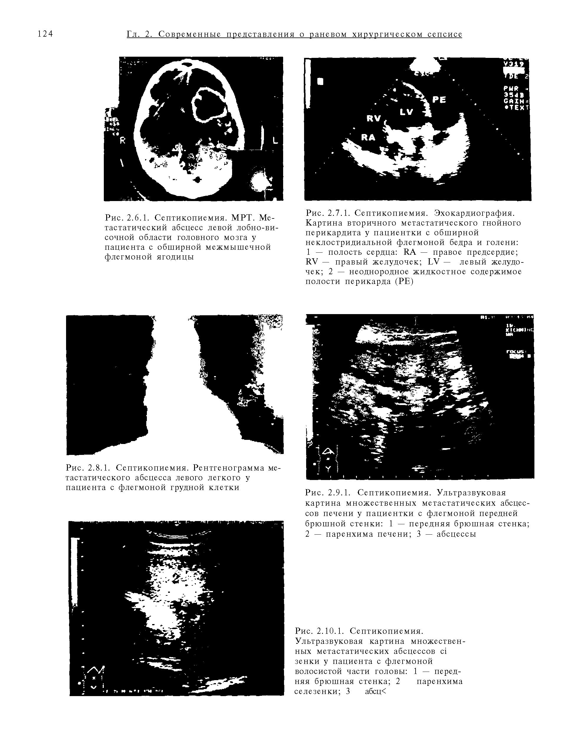 Рис. 2.10.1. Септикопиемия. Ультразвуковая картина множественных метастатических абсцессов с1 зенки у пациента с флегмоной волосистой части головы 1 — передняя брюшная стенка 2 паренхима селезенки 3 абсц<...
