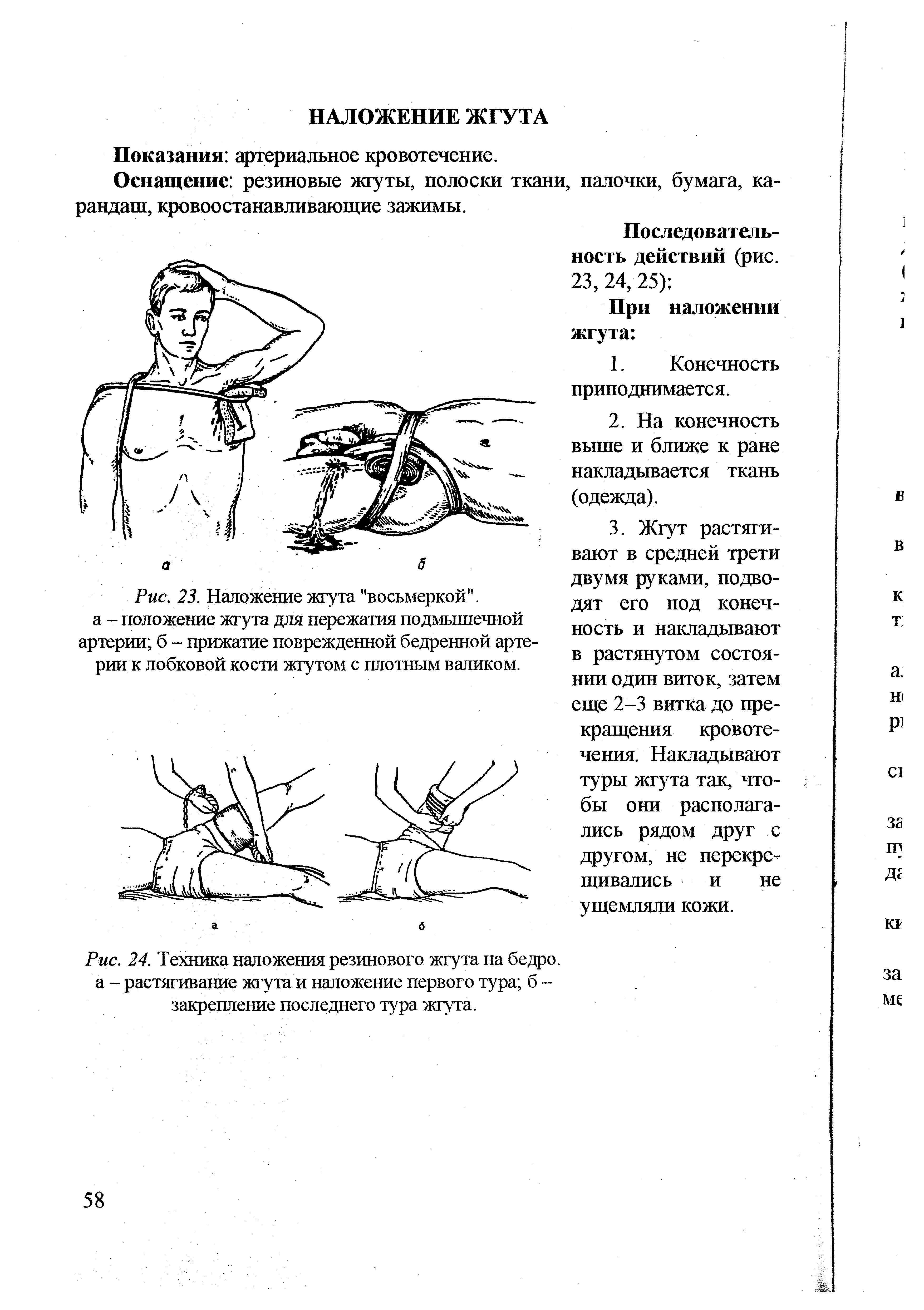 Рис. 24. Техника наложения резинового жгута на бедро, а - растягивание жгута и наложение первого тура б -закрепление последнего тура жгута.