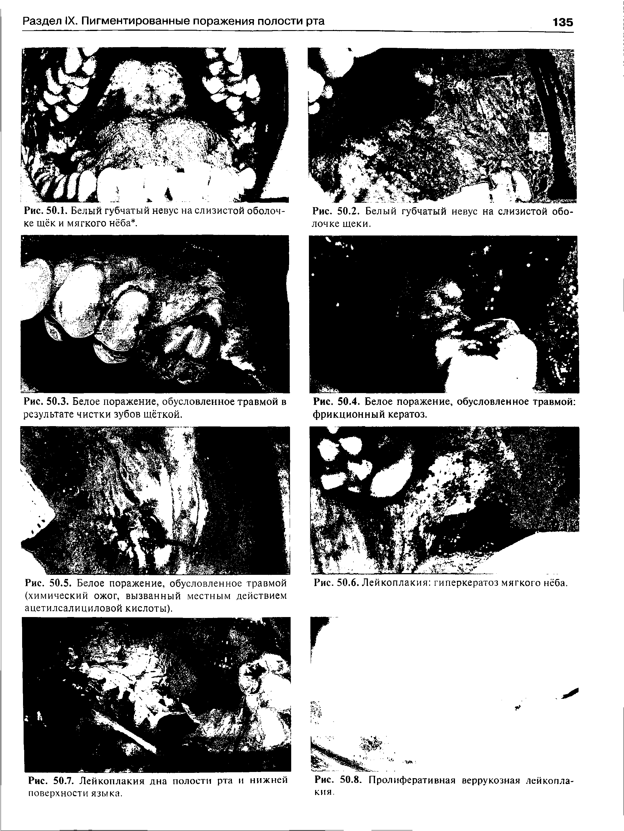 Рис. 50.5. Белое поражение, обусловленное травмой (химический ожог, вызванный местным действием ацетилсалициловой кислоты).