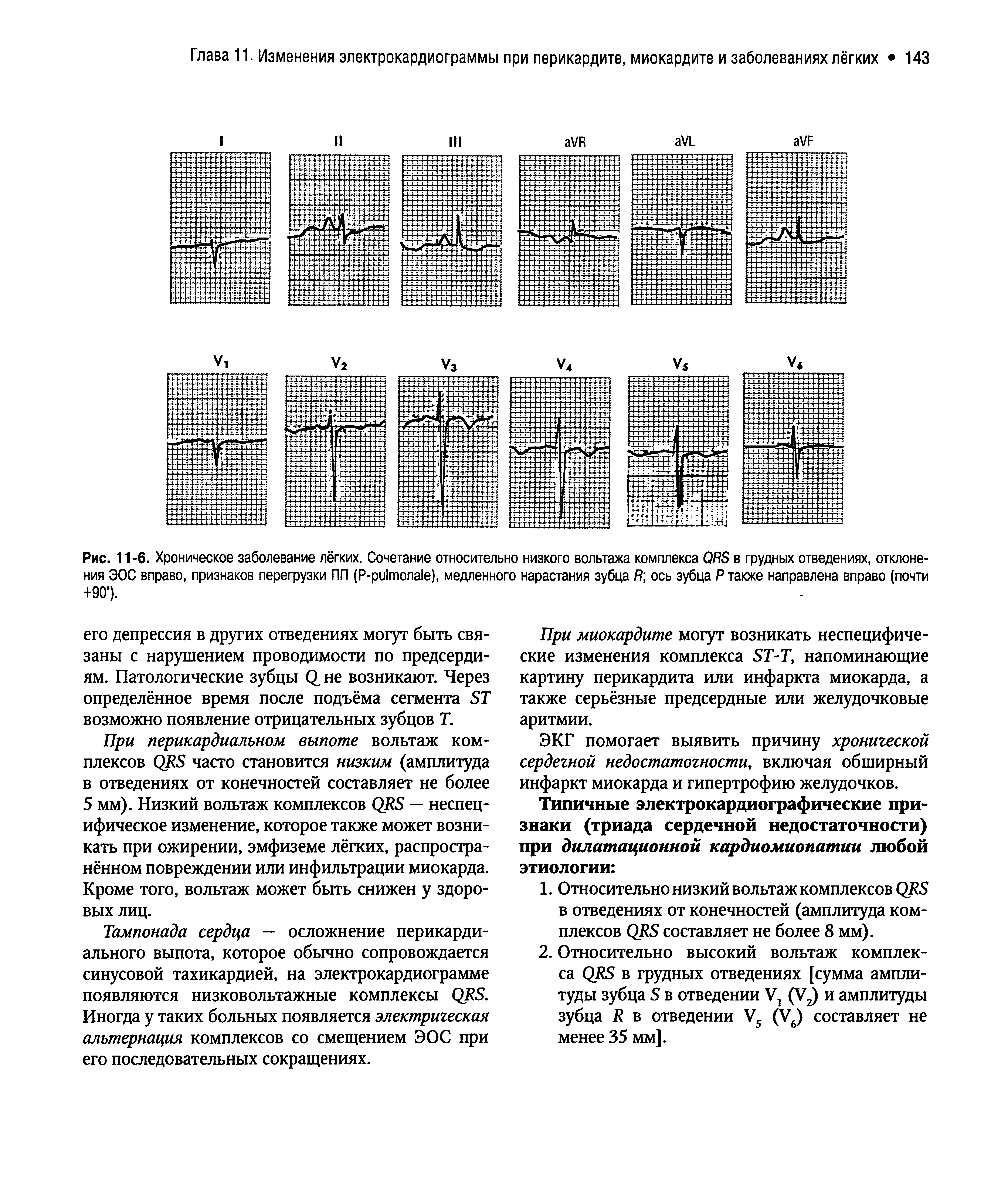 Рис. 11 -6. Хроническое заболевание лёгких. Сочетание относительно низкого вольтажа комплекса ОЯБ в грудных отведениях, отклонения ЭОС вправо, признаков перегрузки ПП (Р-ри1топа1е), медленного нарастания зубца Я ось зубца Р также направлена вправо (почти +90°).