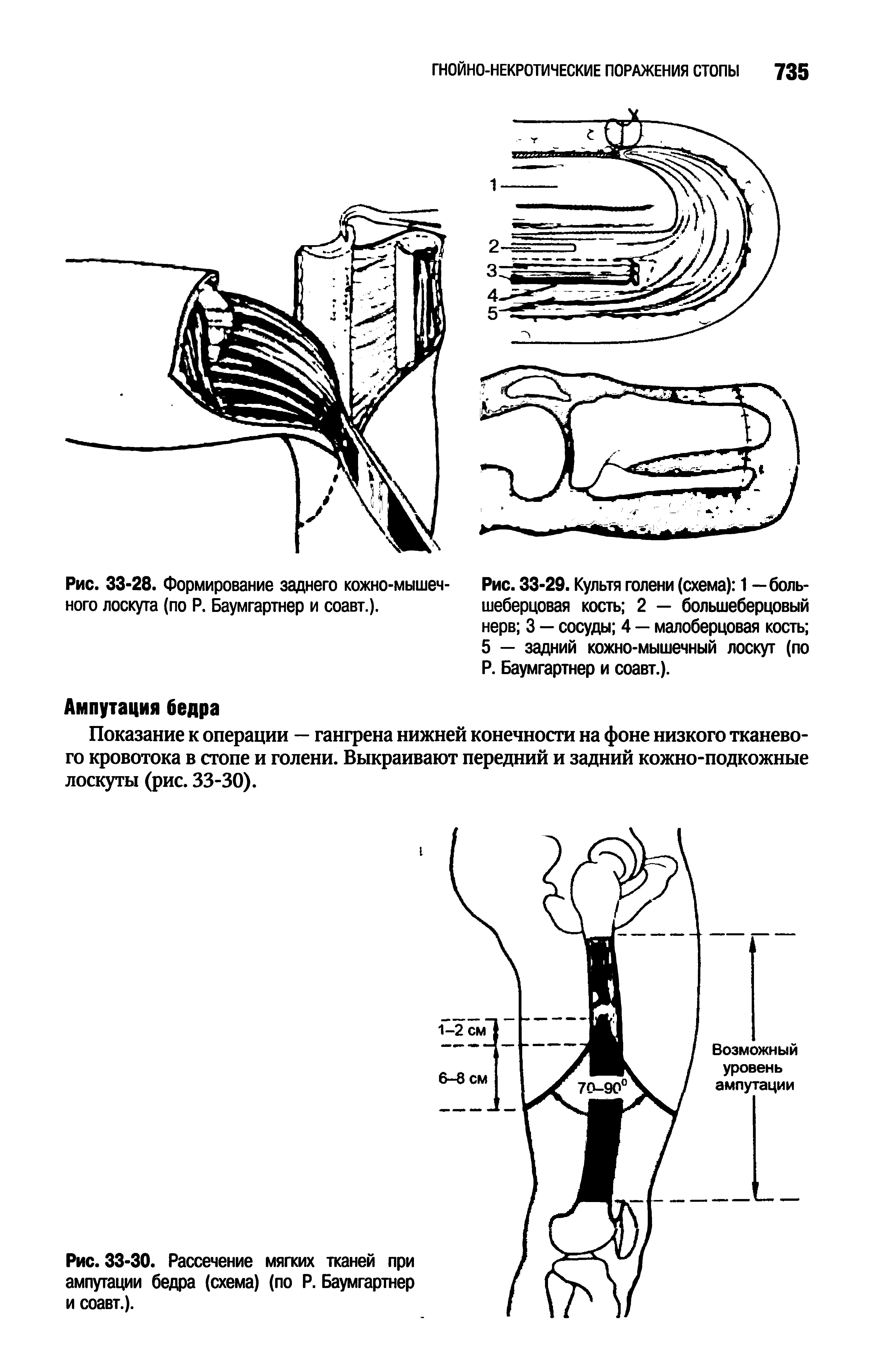 Рис. 33-30. Рассечение мягких тканей при ампутации бедра (схема) (по Р. Баумгартнер и соавт.).