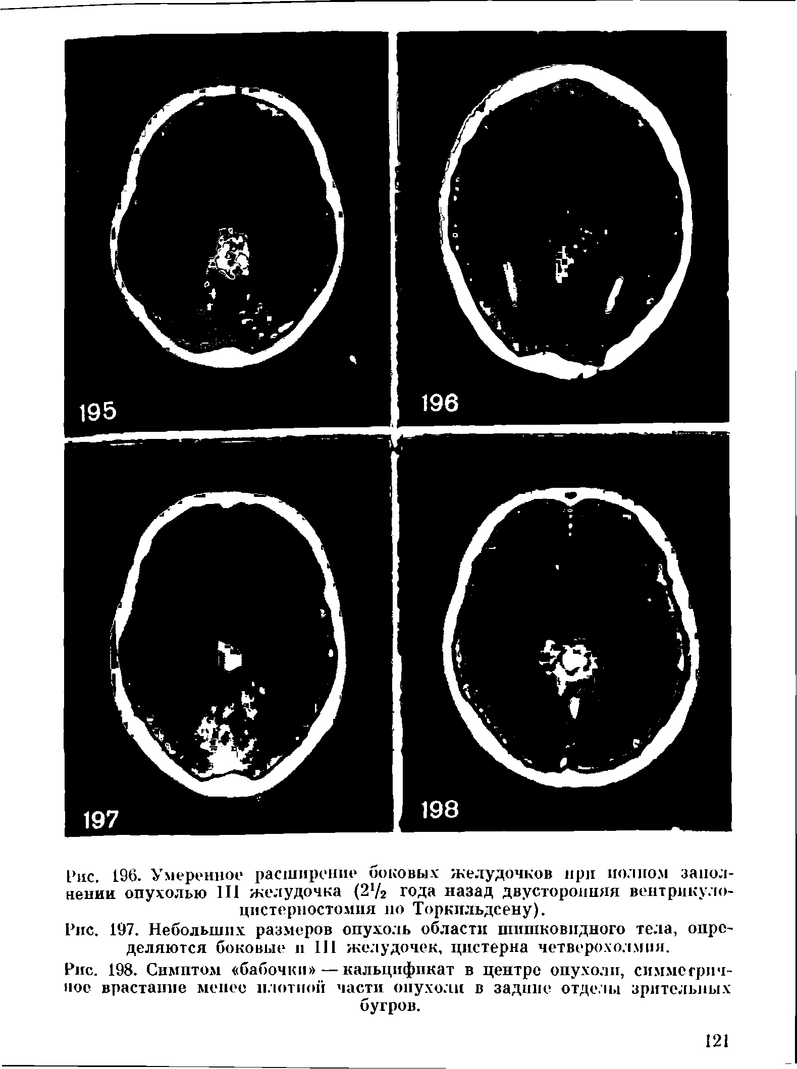 Рис. 198. Симптом бабочки — кальцифпкат в центре опухоли, симметричное врастание менее плотной части опухоли в задние отделы зрительных бугров.