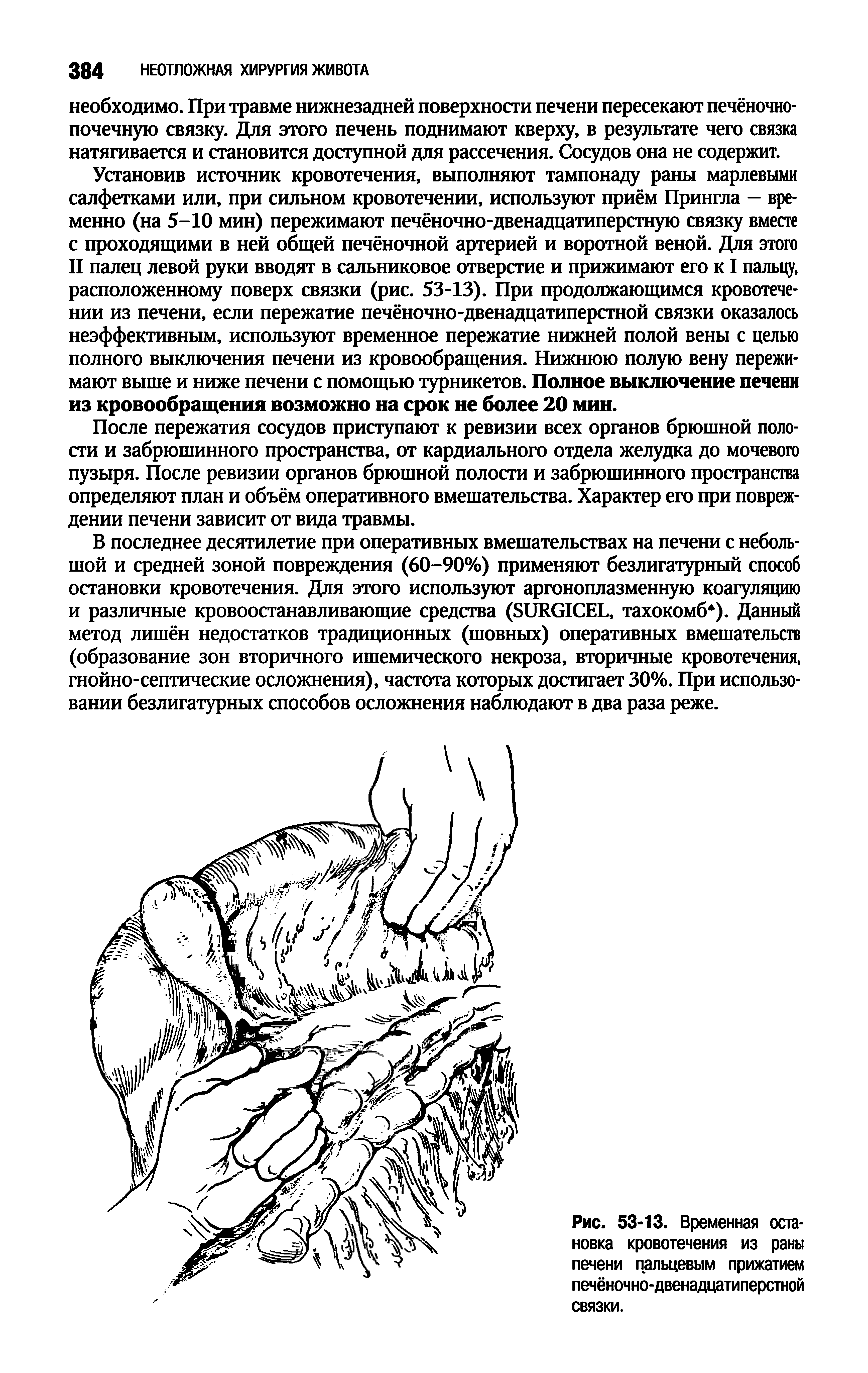 Рис. 53-13. Временная остановка кровотечения из раны печени пальцевым прижатием печёночно-двенадцатиперстной связки.