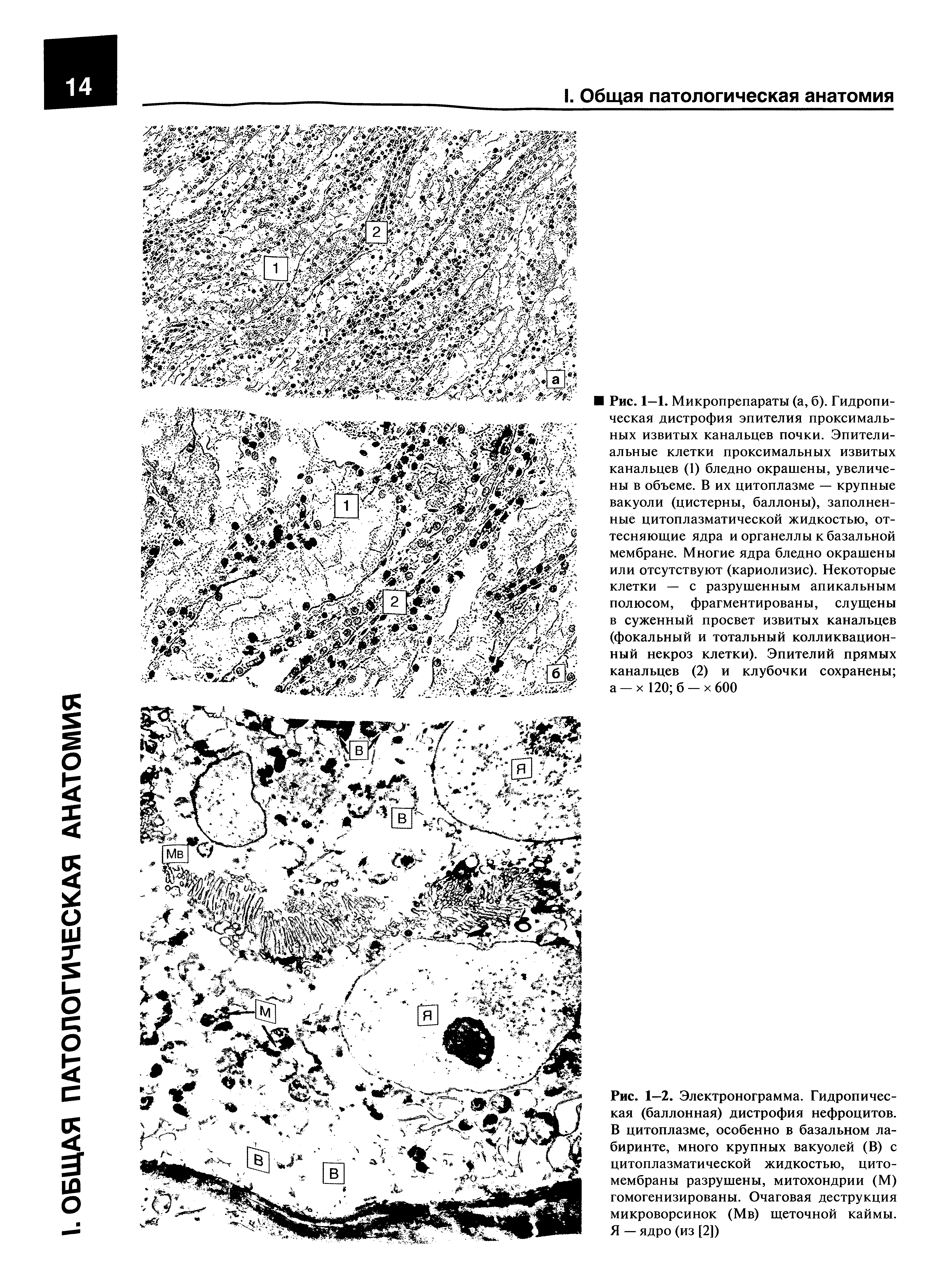 Рис. 1—2. Электронограмма. Гидропическая (баллонная) дистрофия нефроцитов. В цитоплазме, особенно в базальном лабиринте, много крупных вакуолей (В) с цитоплазматической жидкостью, цитомембраны разрушены, митохондрии (М) гомогенизированы. Очаговая деструкция микроворсинок (Мв) щеточной каймы. Я — ядро (из [2])...