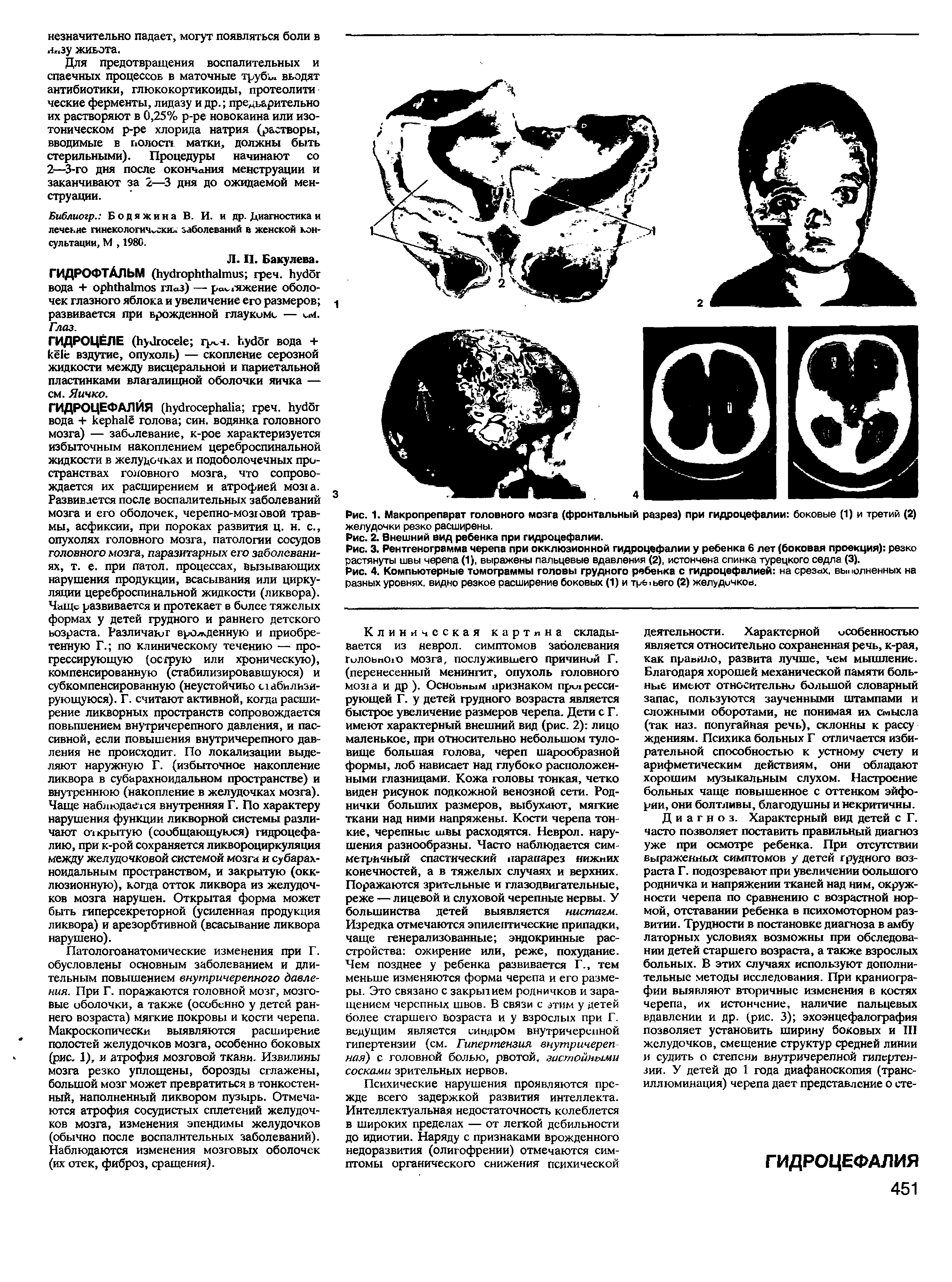 Рис. 1. Макропрепарат головного мозга (фронтальный разрез) при гидроцефалии боковые (1) и третий (2) желудочки резко расширены.