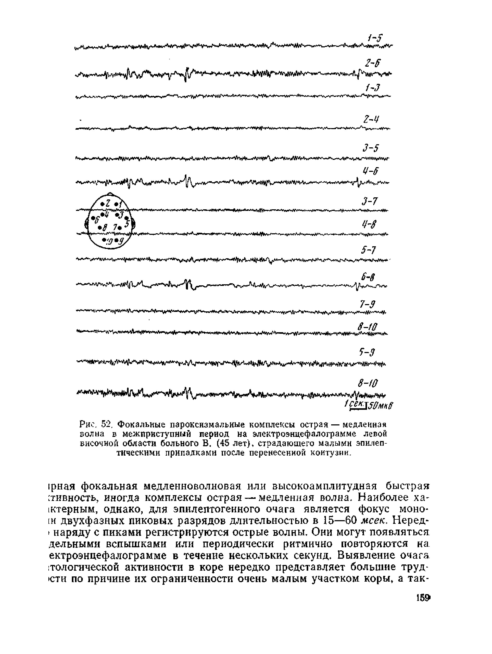 Рис. 52, Фокальные пароксизмальные комплексы острая — медленная волна в межприступный период на электроэнцефалограмме левой височной области больного В. (45 лет), страдающего малыми эпилептическими припадками после перенесенной контузии.
