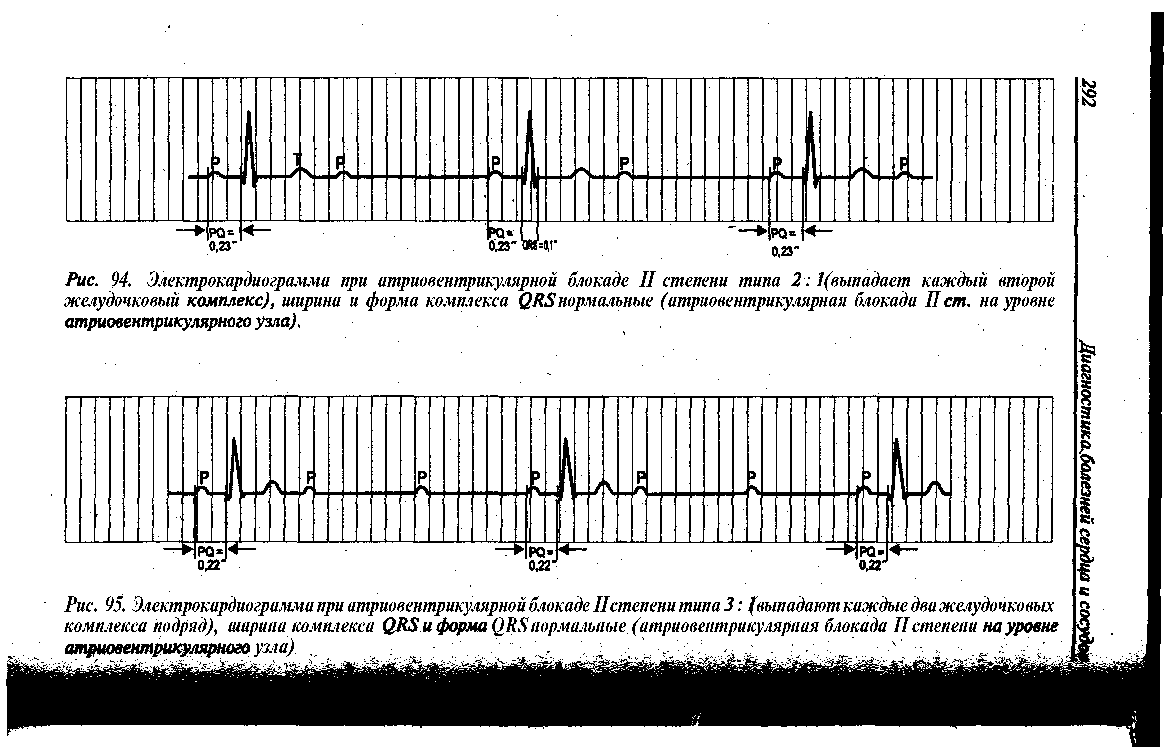 Рис. 95. Электрокардиограмма при атриовентрикулярной блокаде IIстепени типа 3 (выпадают каждые два желудочковых комплекса подряд), ширина комплекса QRS и форма QRSнормальные (атриовентрикулярная блокада IIстепени на уровне атриовентрикулярного узла) ...