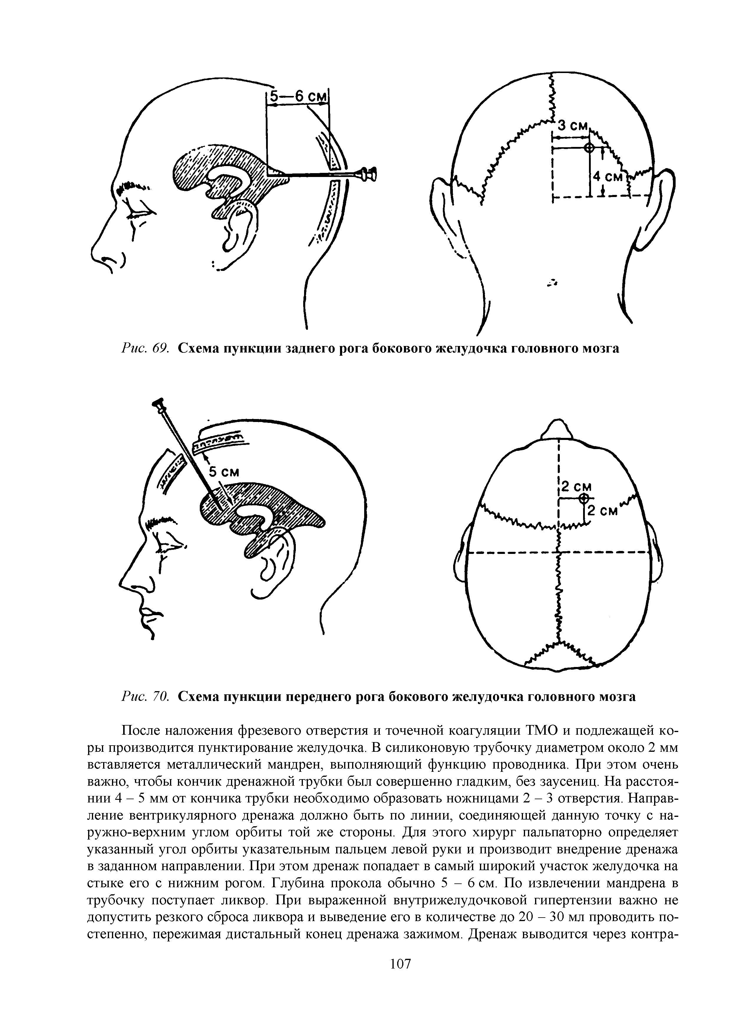 Рис. 70. Схема пункции переднего рога бокового желудочка головного мозга...