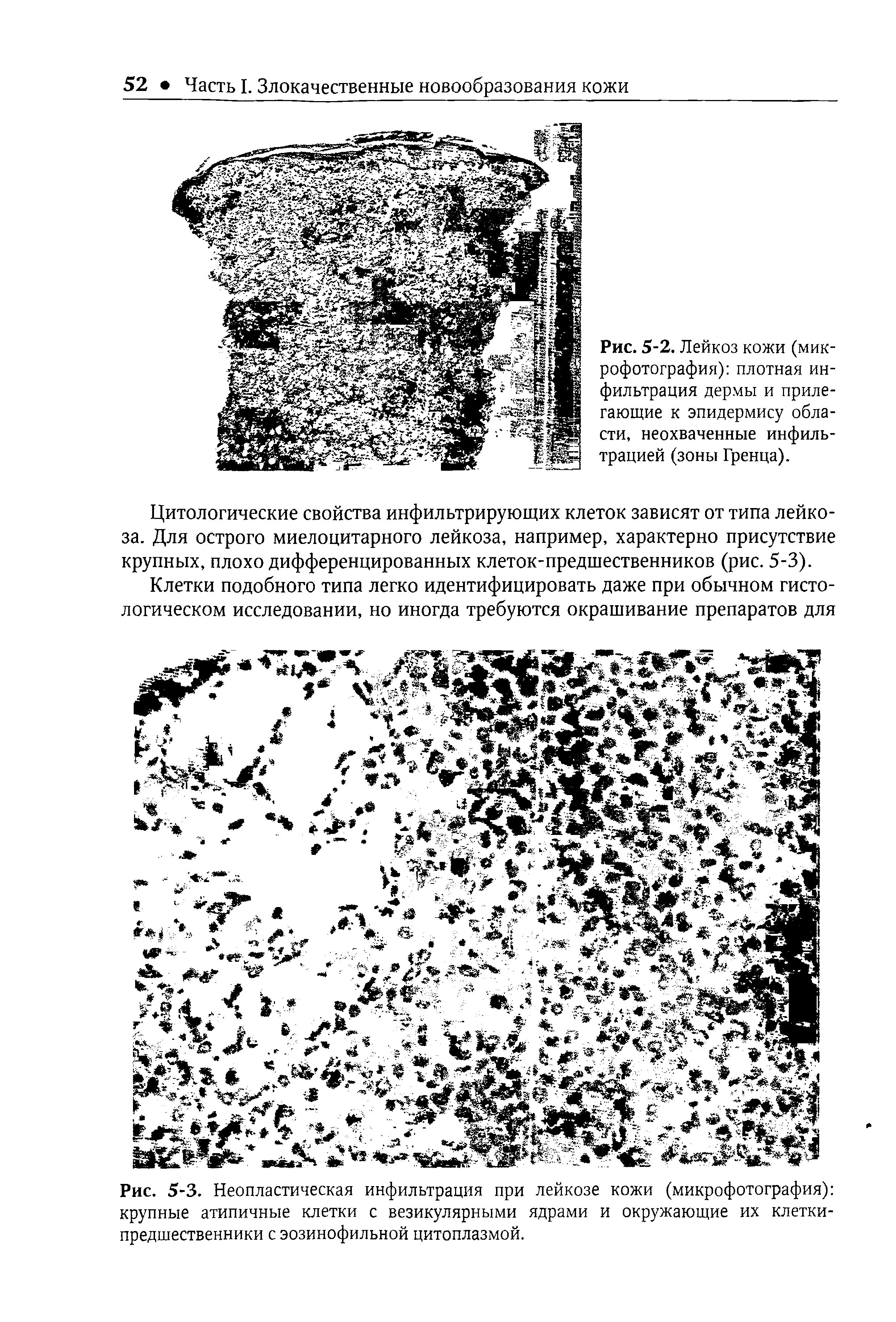 Рис. 5-2. Лейкоз кожи (микрофотография) плотная инфильтрация дермы и прилегающие к эпидермису области, неохваченные инфильтрацией (зоны Гренца).