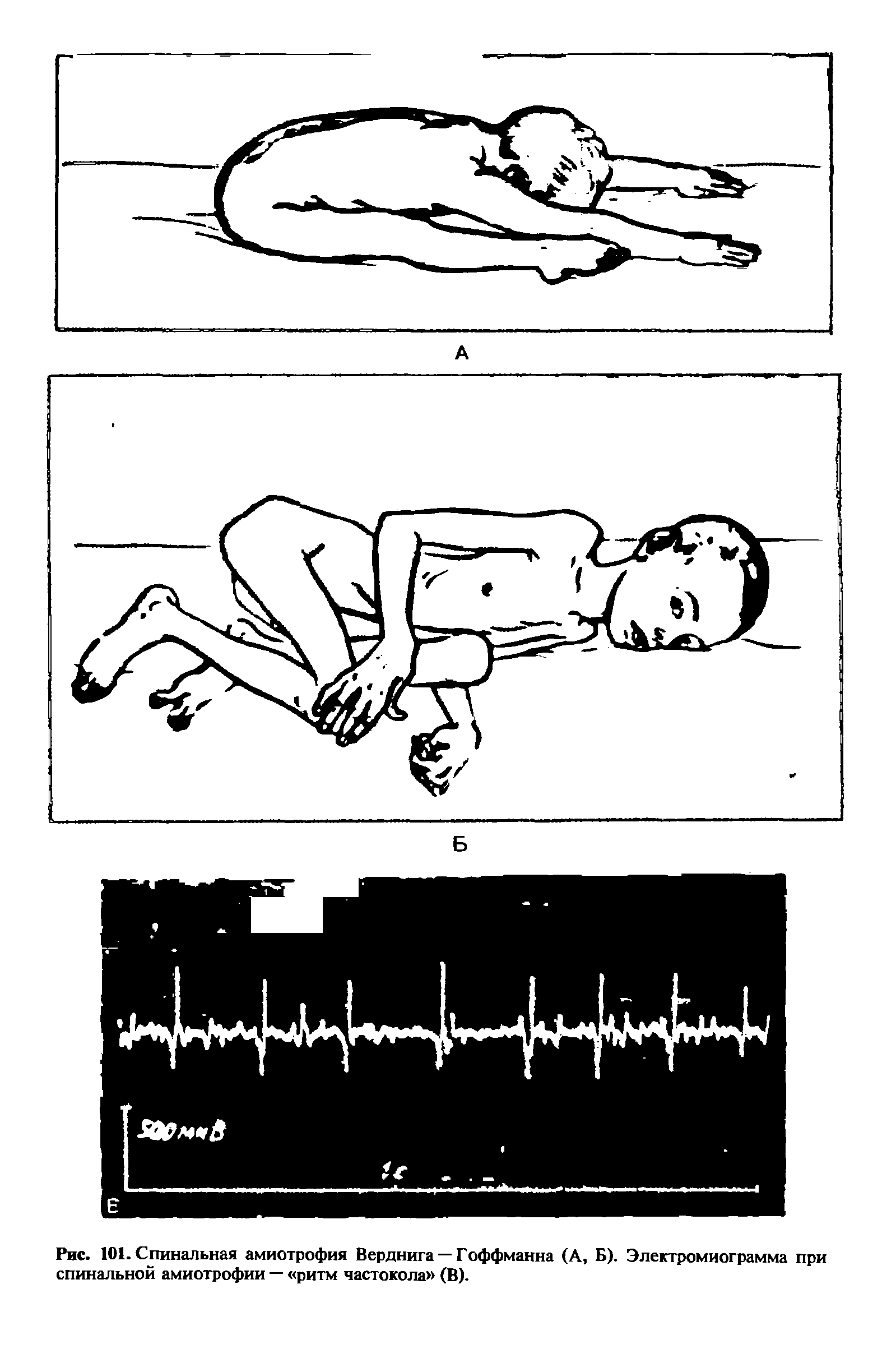 Рис. 101. Спинальная амиотрофия Верднига — Гоффманна (А, Б). Элеггромиограмма при спинальной амиотрофии — ритм частокола (В).