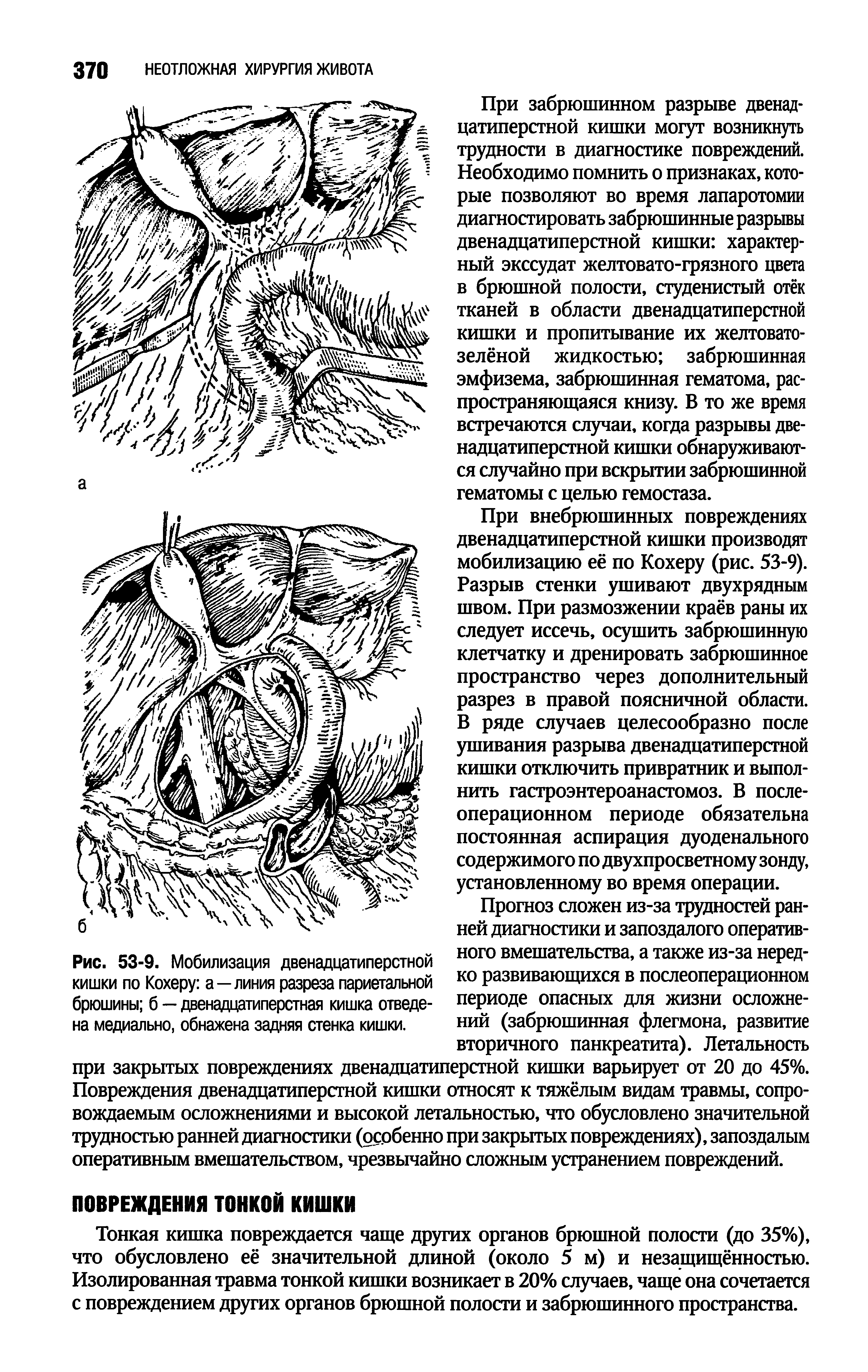 Рис. 53-9. Мобилизация двенадцатиперстной кишки по Кохеру а—линия разреза париетальной брюшины б — двенадцатиперстная кишка отведена медиально, обнажена задняя стенка кишки.