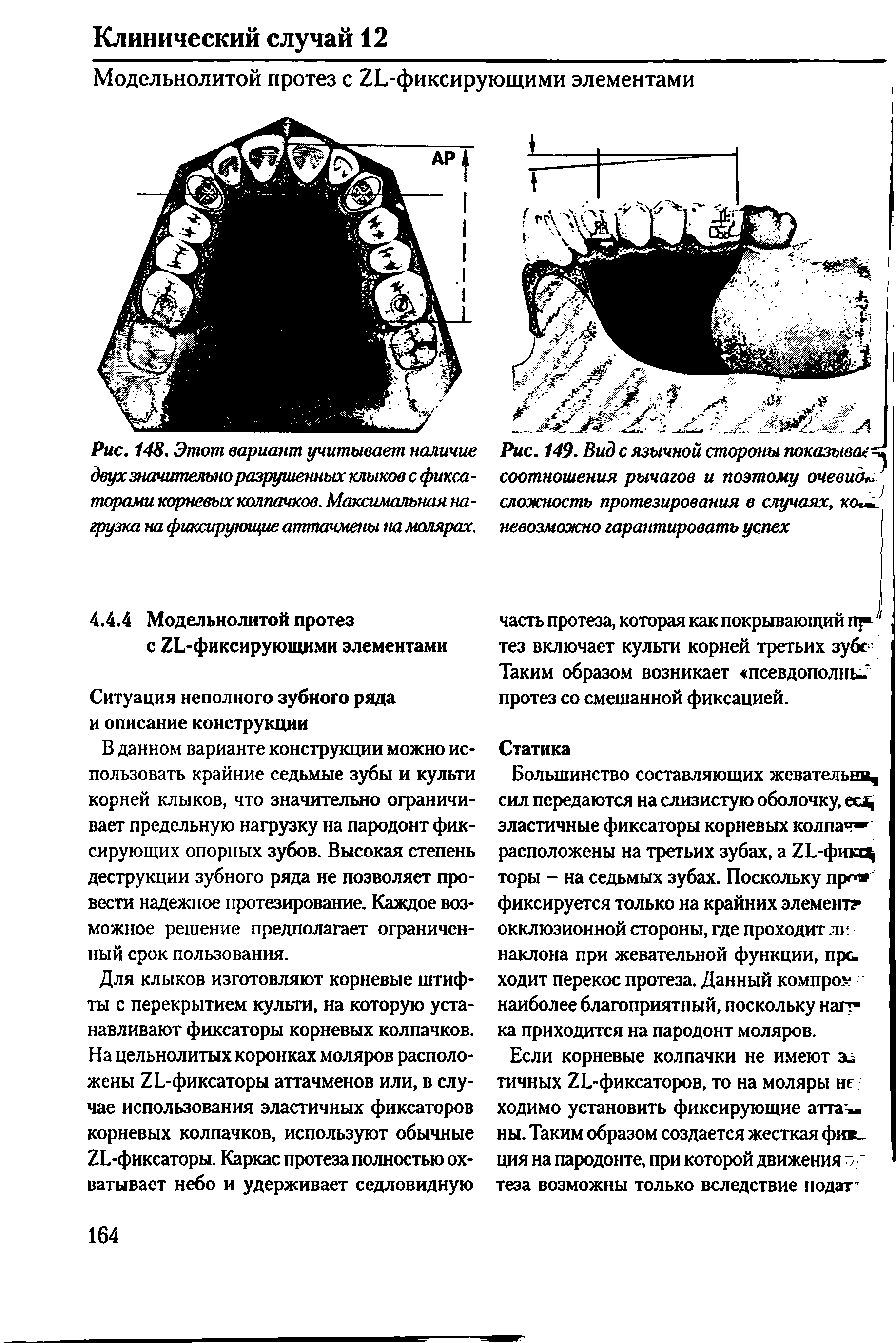 Рис. 148. Этот вариант учитывает наличие двух значительно разрушенных клыков с фиксаторами корневых колпачков. Максимальная нагрузка на фиксирующие аттачмены на малярах.