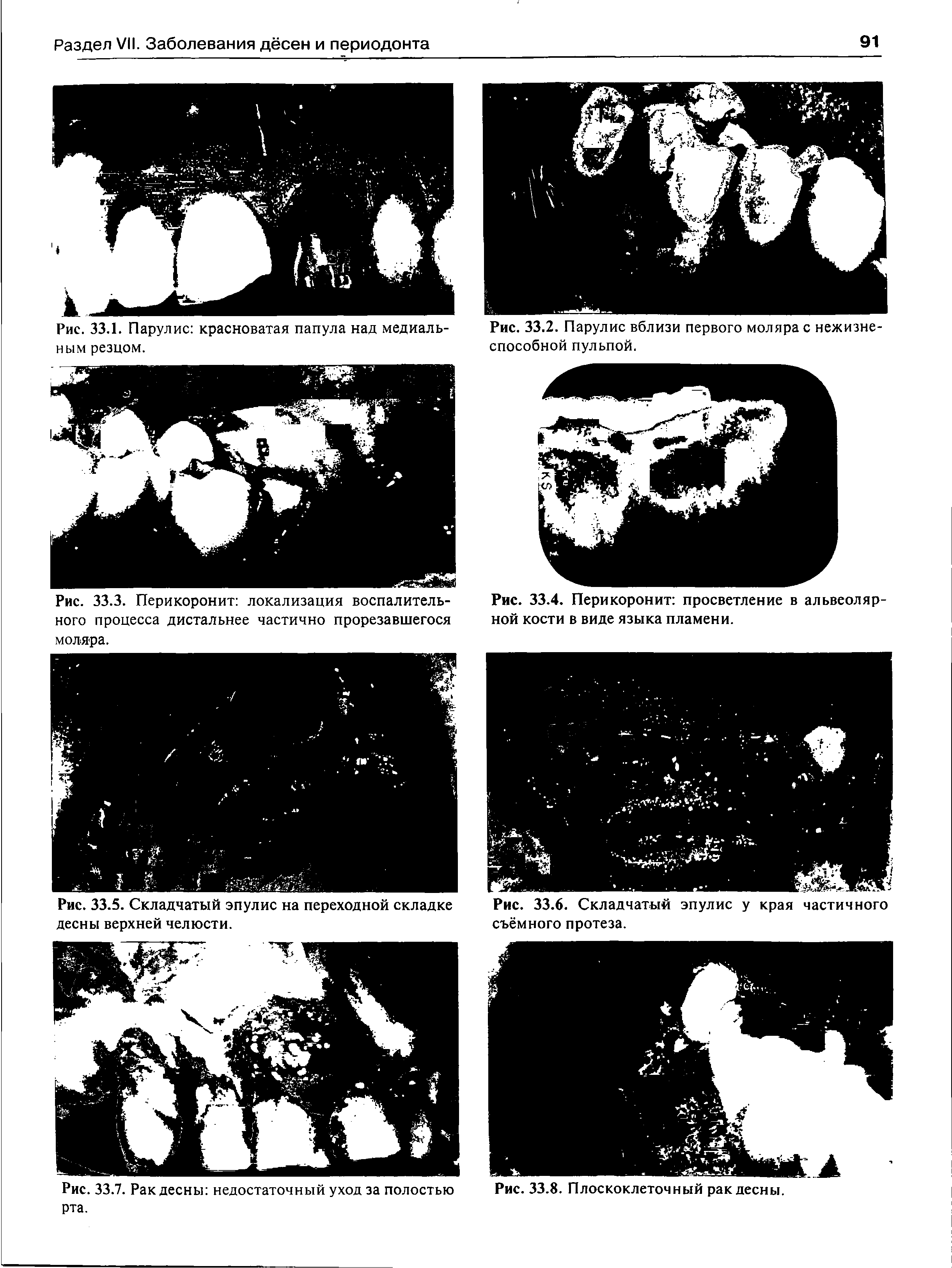 Рис. 33.5. Складчатый эпулис на переходной складке Рис. 33.6. Складчатый эпулис у края частичного десны верхней челюсти. съёмного протеза.