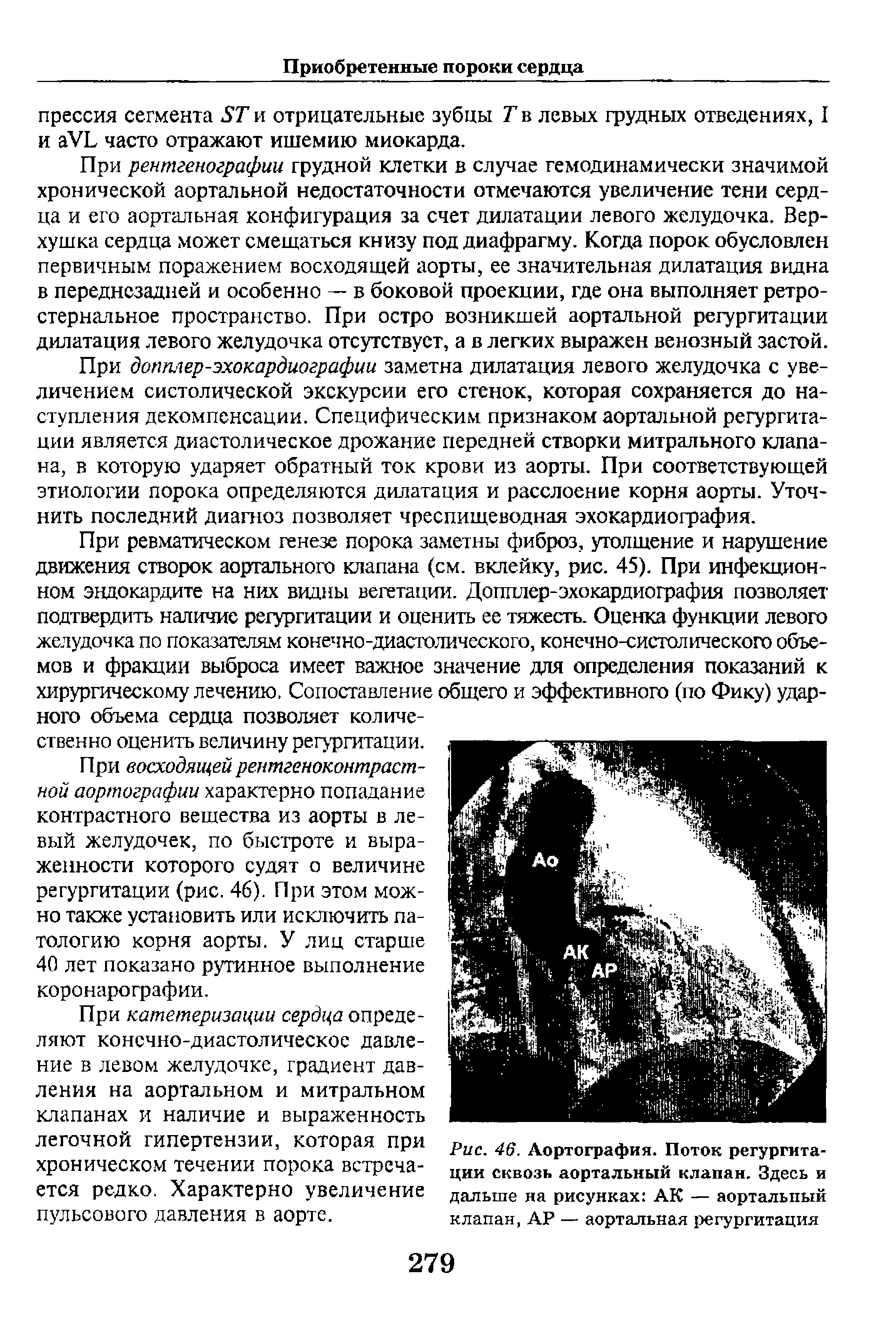 Рис. 46. Аортография. Поток регургитации сквозь аортальный клапан. Здесь и дальше на рисунках АК — аортальный клапан, АР — аортальная регургитация...