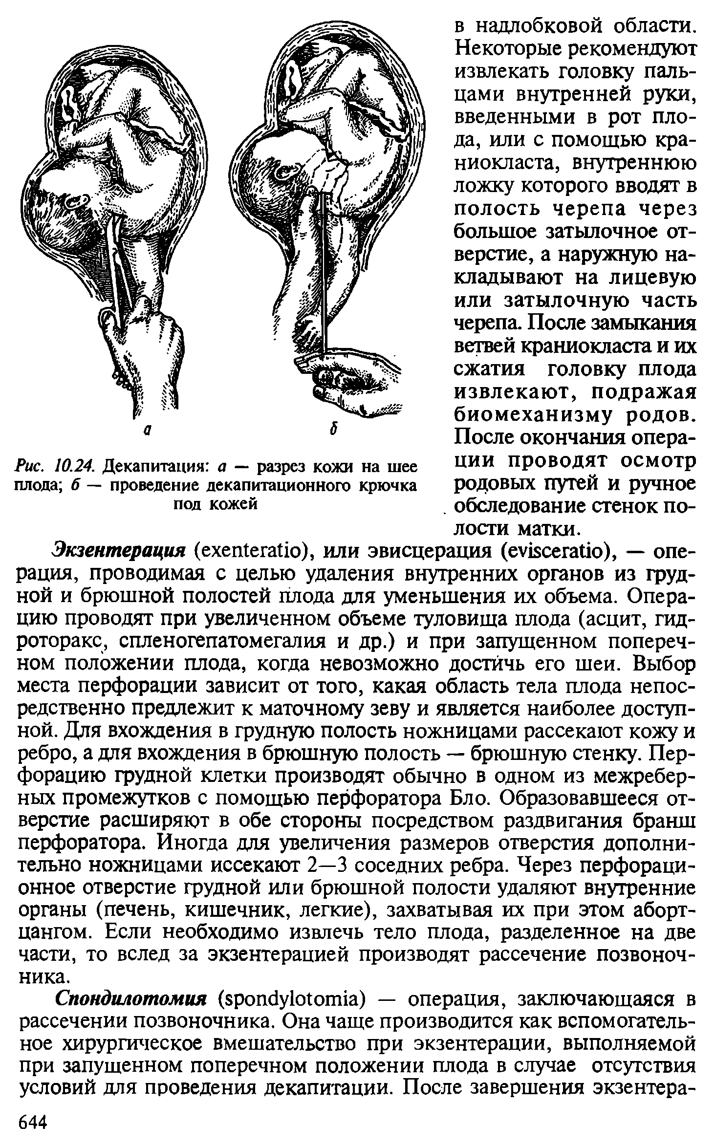 Рис. 10.24. Декапитация а — разрез кожи на шее плода б — проведение декапитационного крючка под кожей...