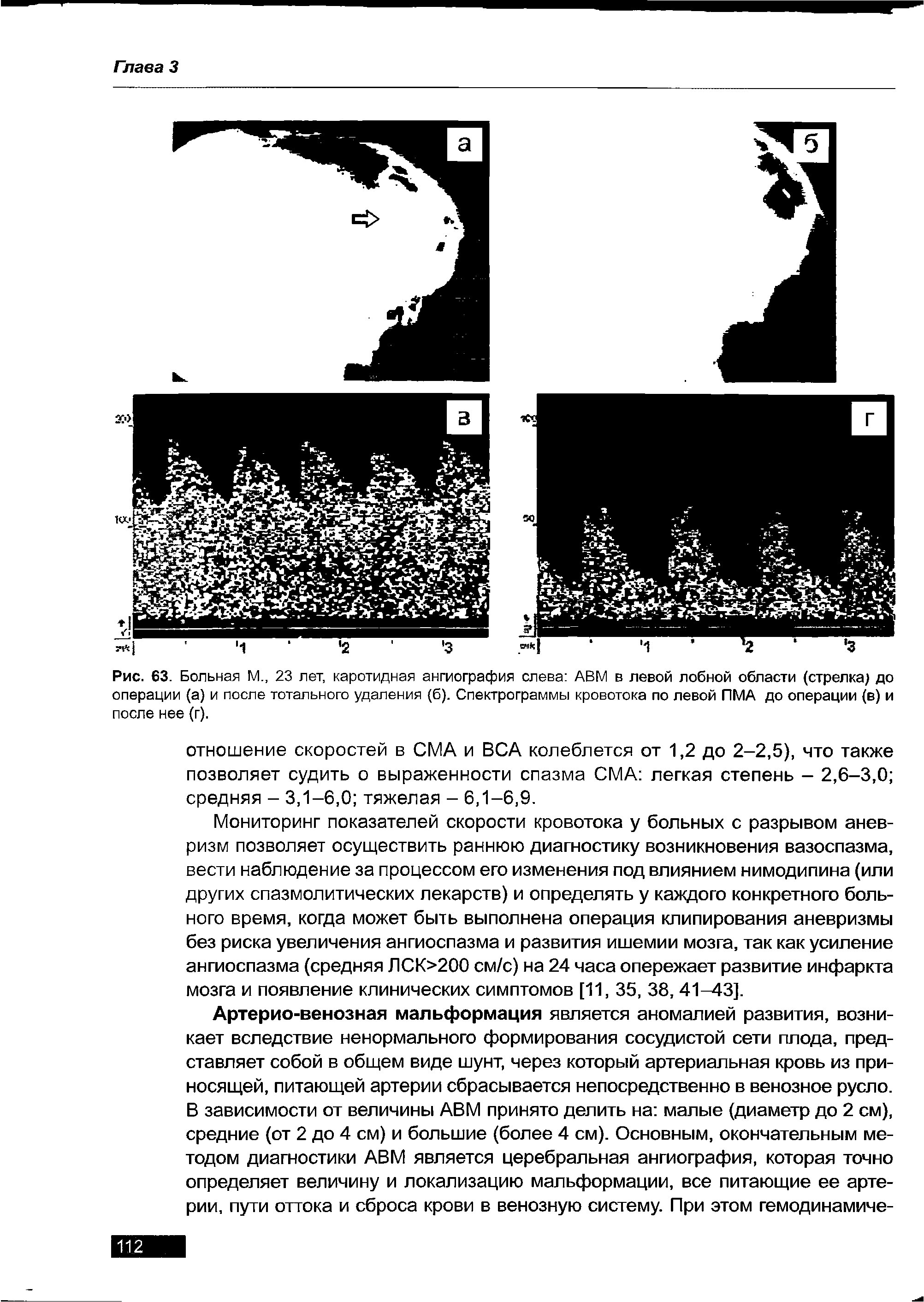 Рис. 63. Больная М., 23 лет, каротидная ангиография слева АВМ в левой лобной области (стрелка) до операции (а) и после тотального удаления (б). Спектрограммы кровотока по левой ПМА до операции (в) и после нее (г).