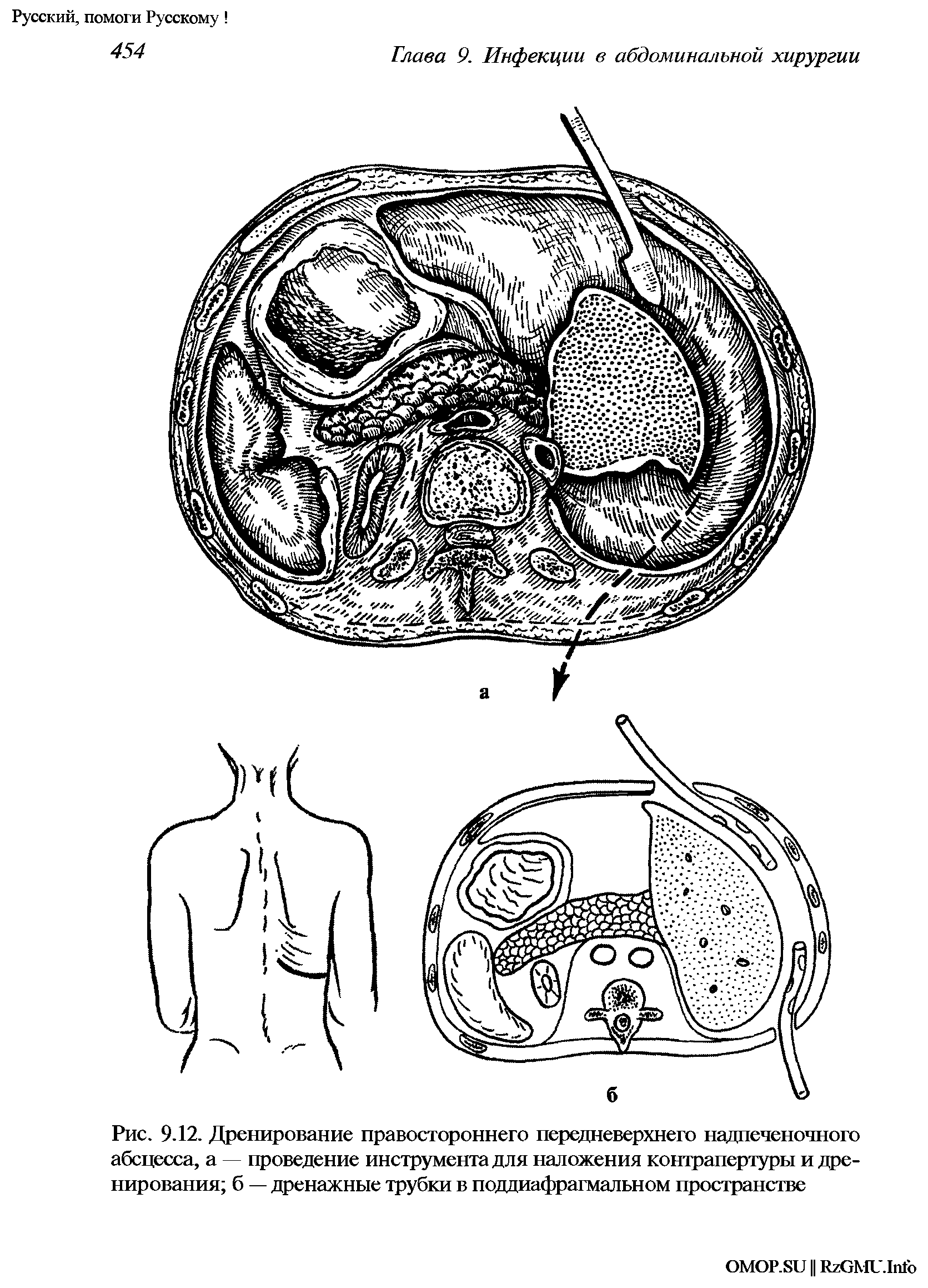 Рис. 9.12. Дренирование правостороннего передневерхнего надпеченочного абсцесса, а проведение инструмента для наложения контрапертуры и дренирования б — дренажные трубки в поддиафрагмальном пространстве...