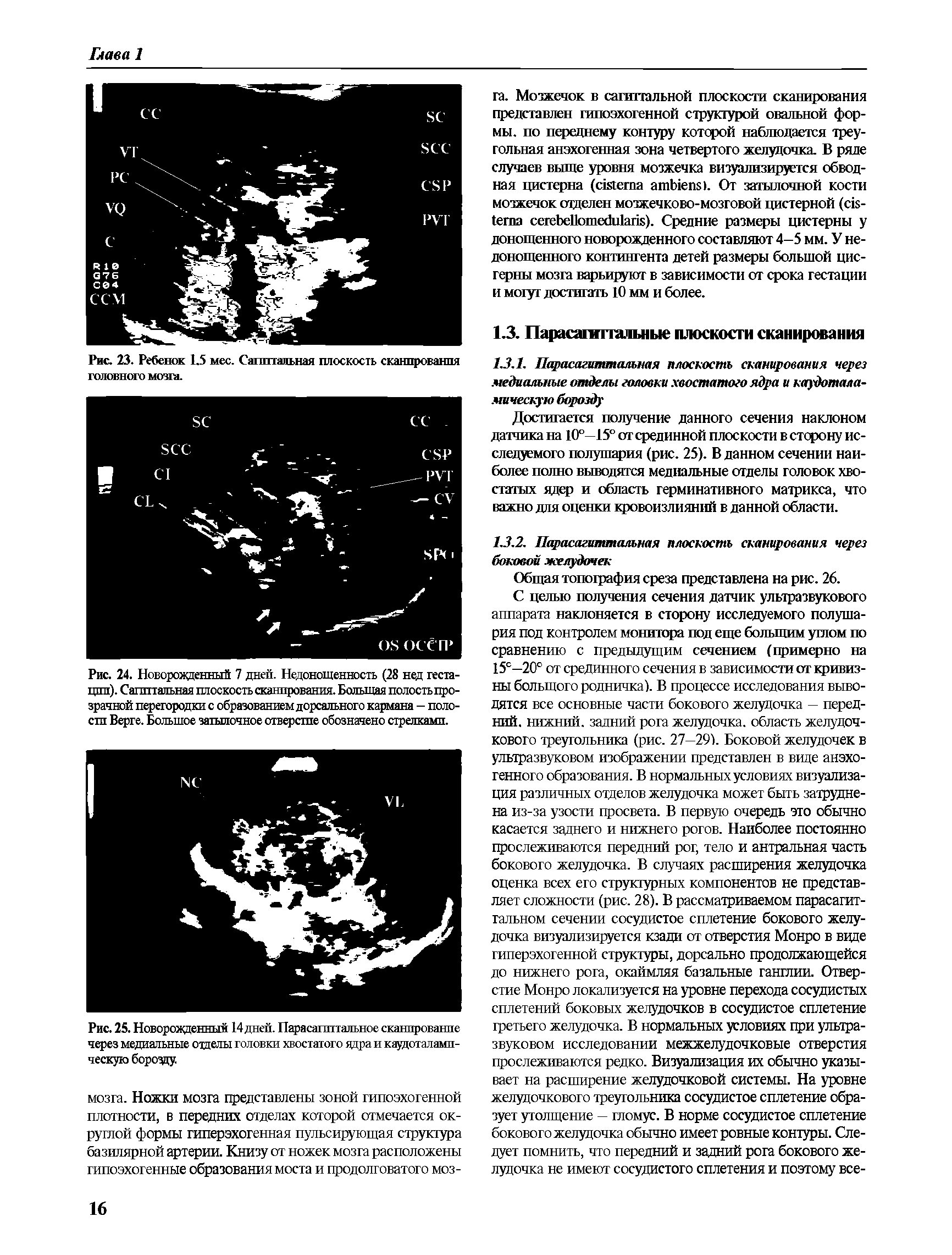 Рис. 23. Ребенок 1.5 мес. Сагиттальная плоскость сканирования головного мозга.