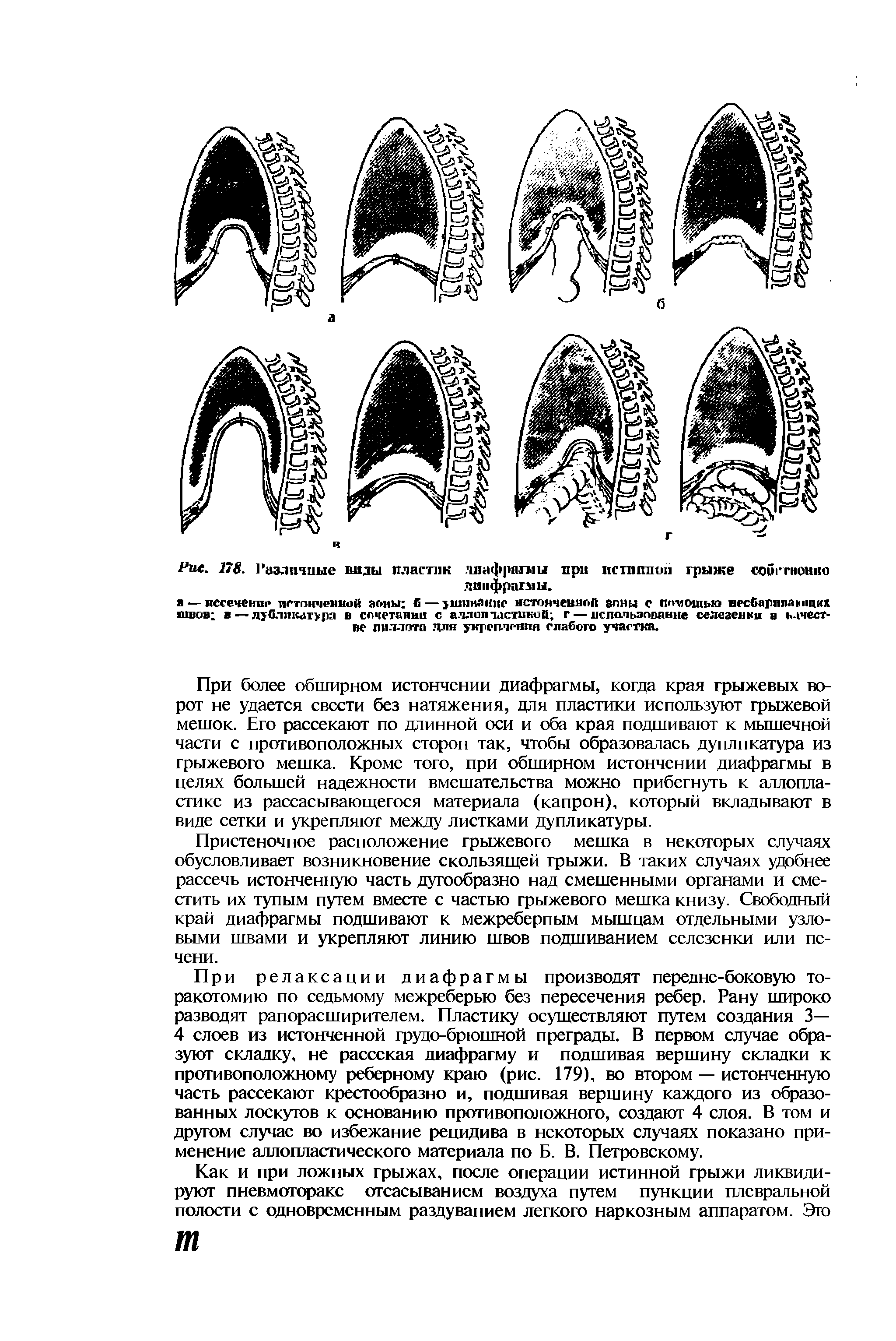Рис. 178. Различные виды пластик диафрагмы при истшпкш грыже собггноино диафрагмы.