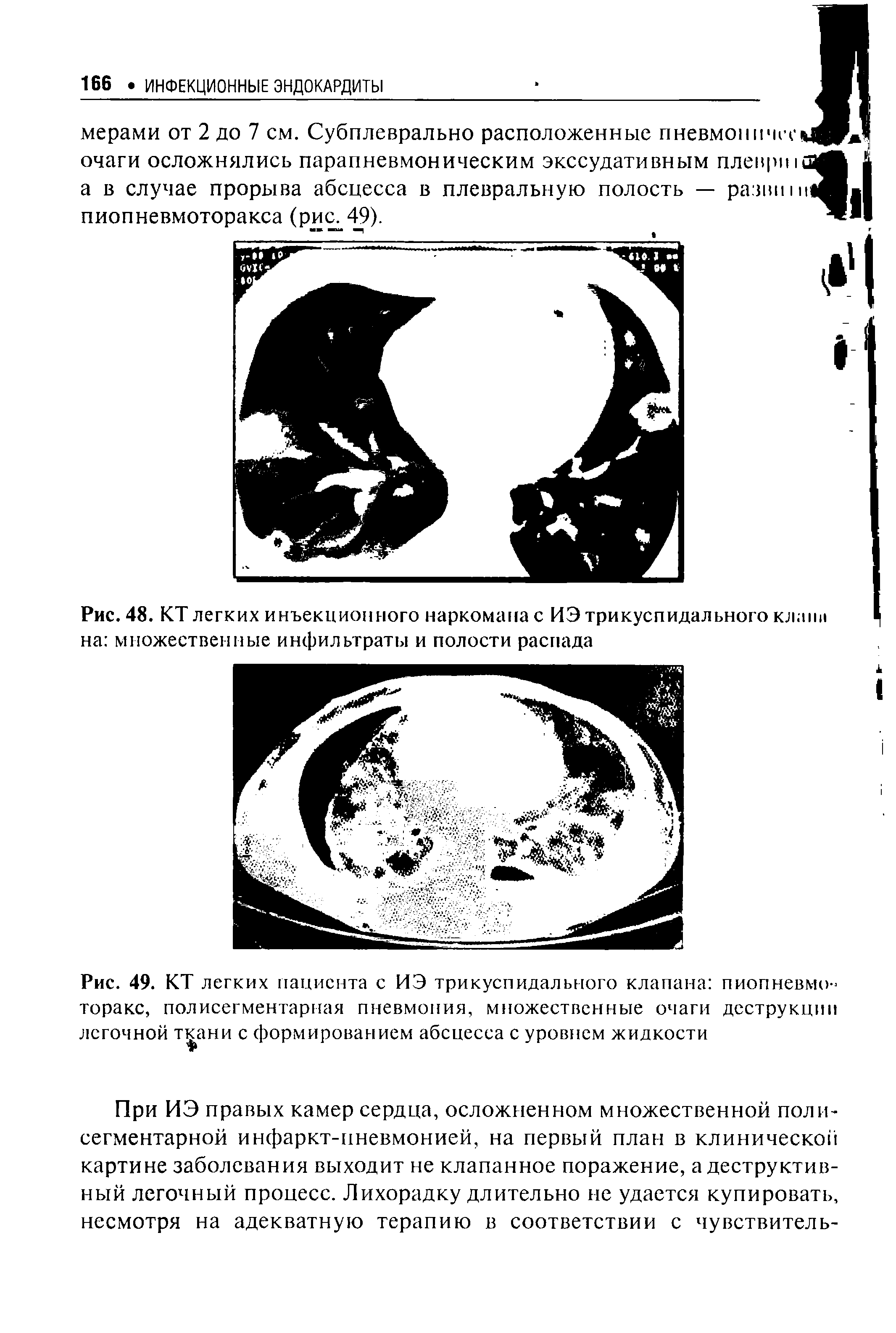 Рис. 49. КТ легких пациента с ИЭ трикуспидального клапана пиопневмо-торакс, полисегментарная пневмония, множественные очаги деструкции легочной ткани с формированием абсцесса с уровнем жидкости...
