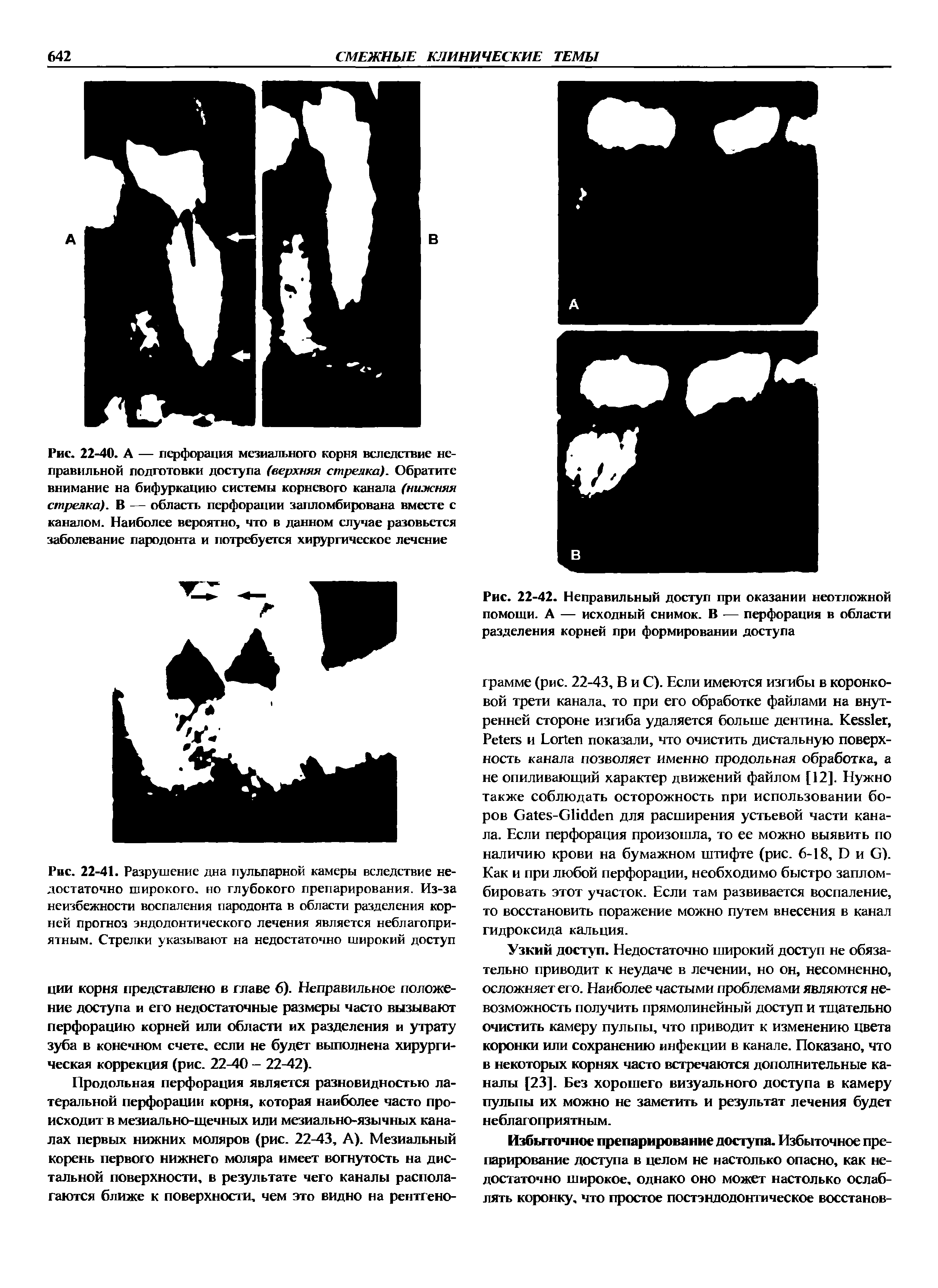Рис. 22-42. Неправильный доступ при оказании неотложной помощи. А — исходный снимок. В — перфорация в области разделения корней при формировании доступа...
