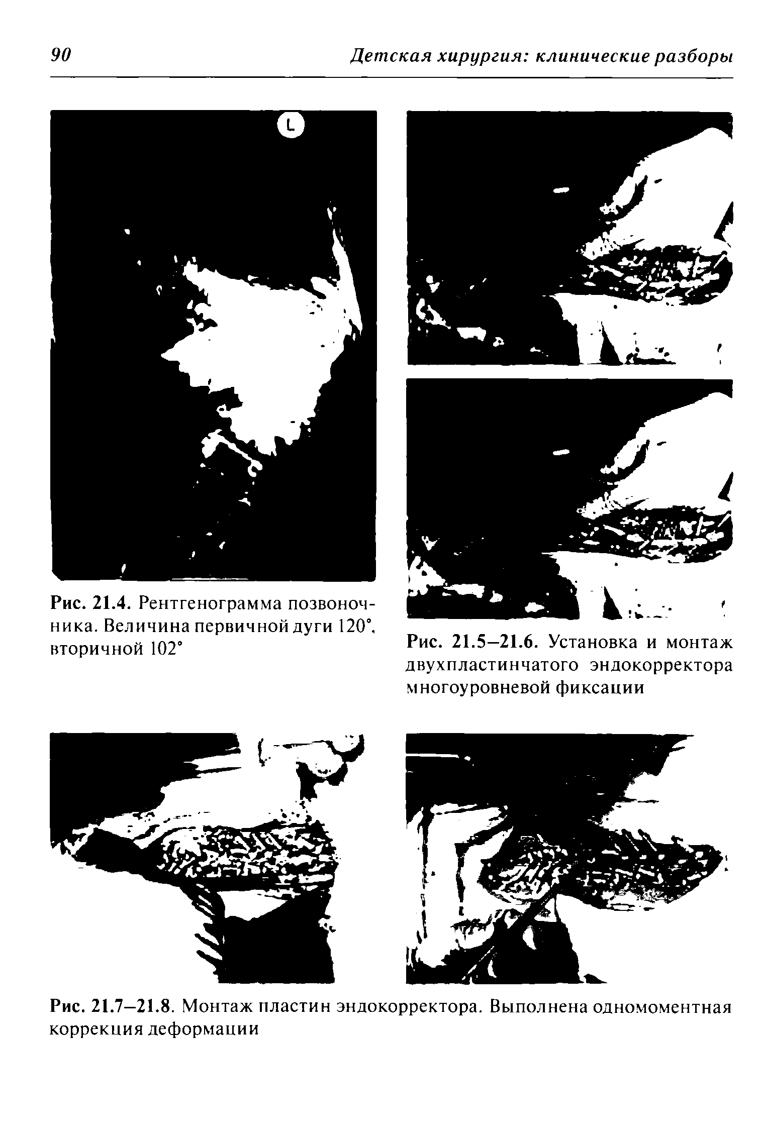 Рис. 21.7—21.8. Монтаж пластин эндокорректора. Выполнена одномоментная коррекция деформации...