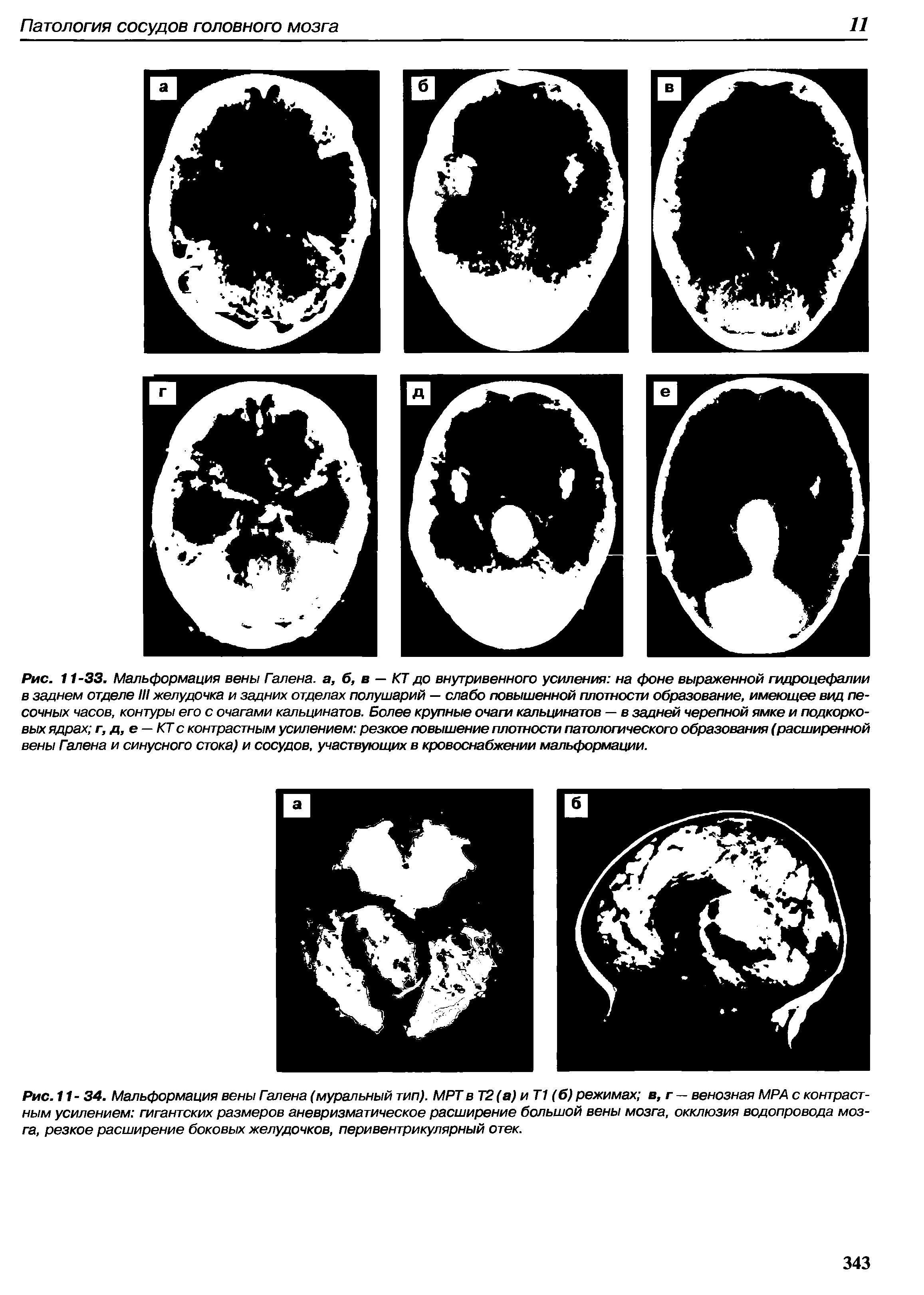 Рис. 11- 34. Мальформация вены Галена (муральный тип). МРТ в Т2 (а) и Т1 (б) режимах в, г — венозная МРА с контрастным усилением гигантских размеров аневризматическое расширение большой вены мозга, окклюзия водопровода мозга, резкое расширение боковых желудочков, перивентрикулярный отек.