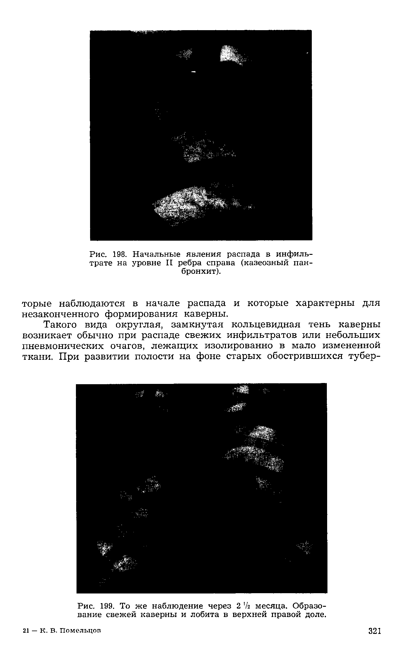 Рис. 199. То же наблюдение через 2 /г месяца. Образование свежей каверны и лобита в верхней правой доле.