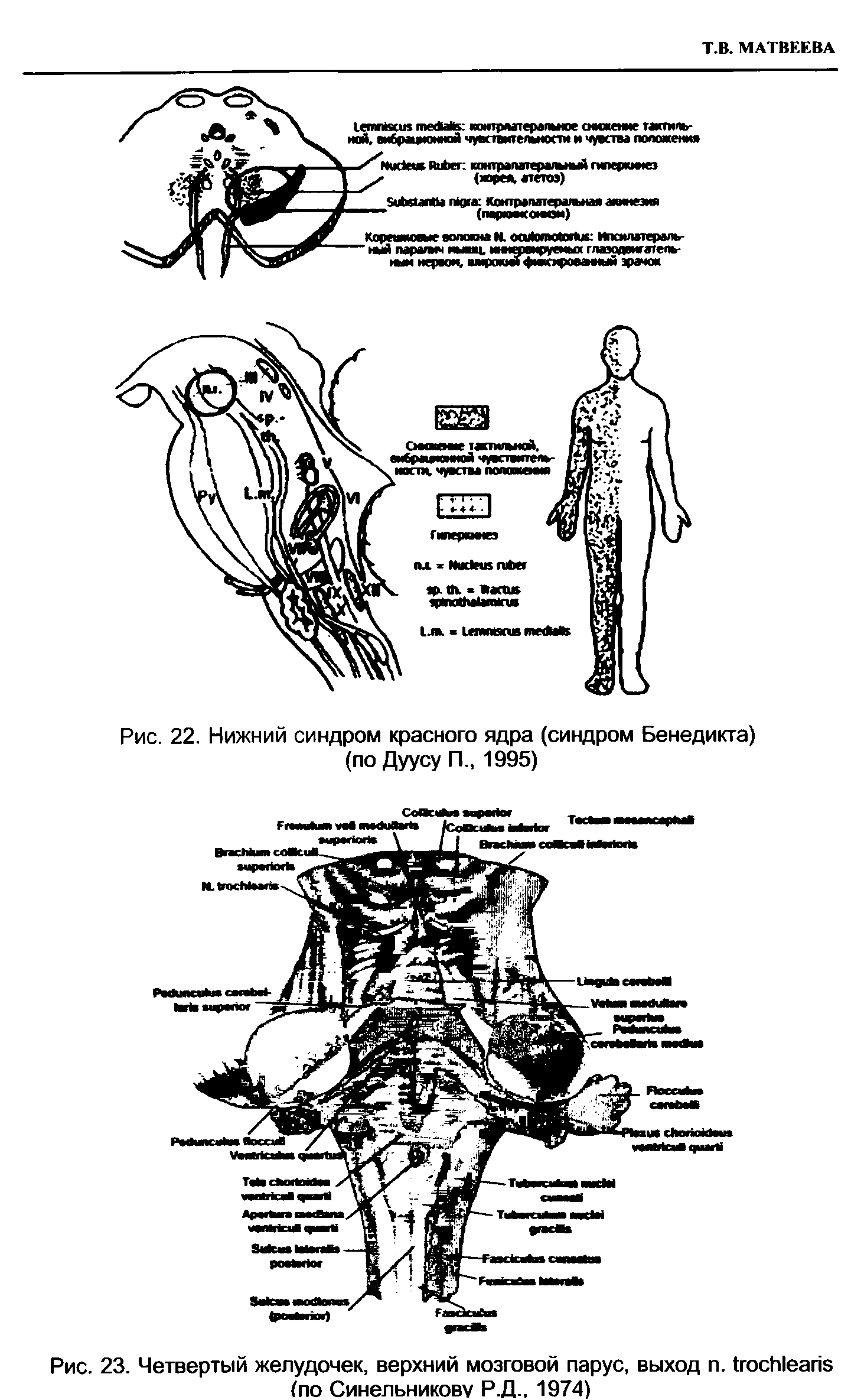 Рис. 23. Четвертый желудочек, верхний мозговой парус, выход п. 1госИ1еапз (по Синельникову Р.Д., 1974)...