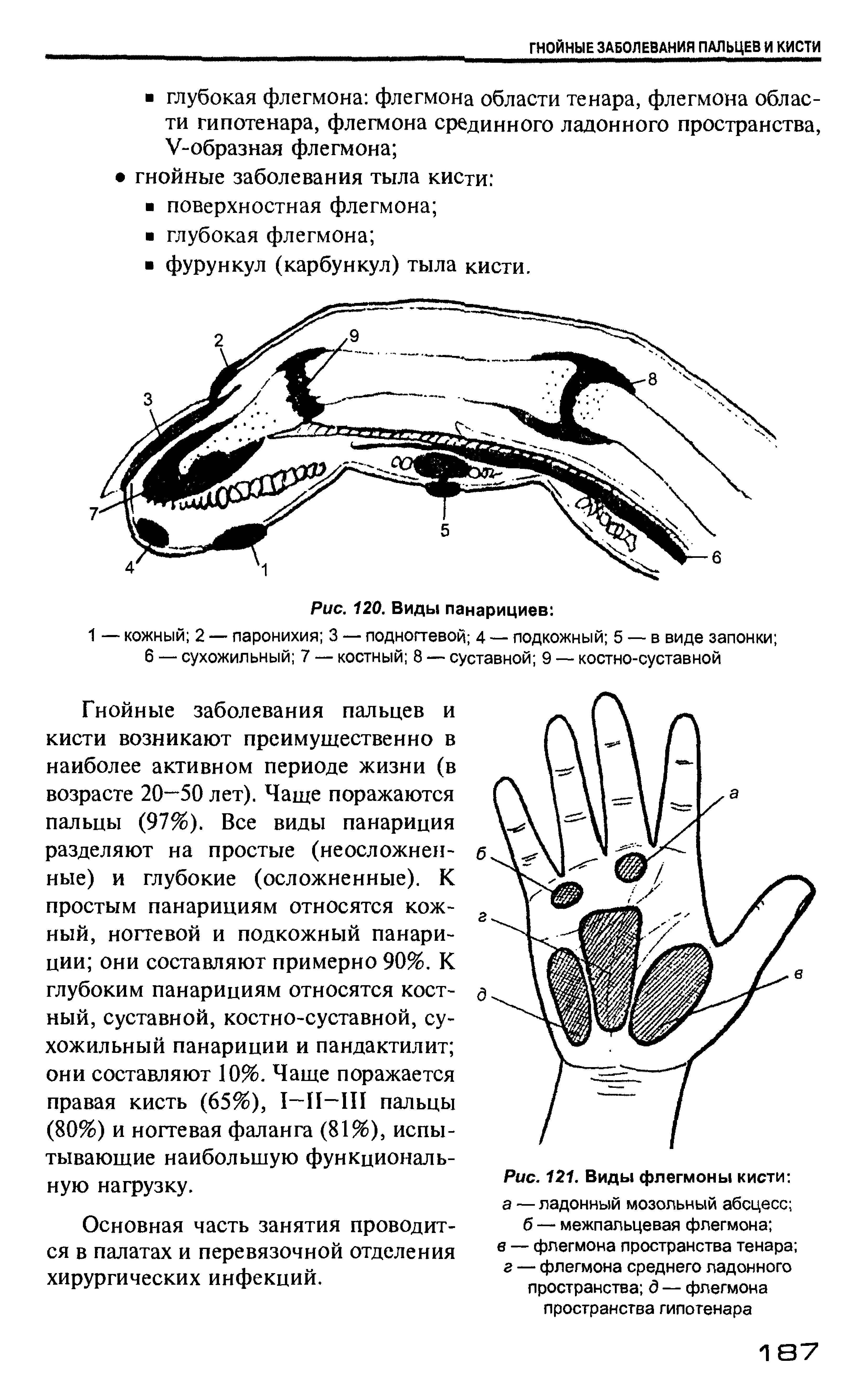 Рис. 121. Виды флегмоны кисти а —ладонный мозольный абсцесс ...