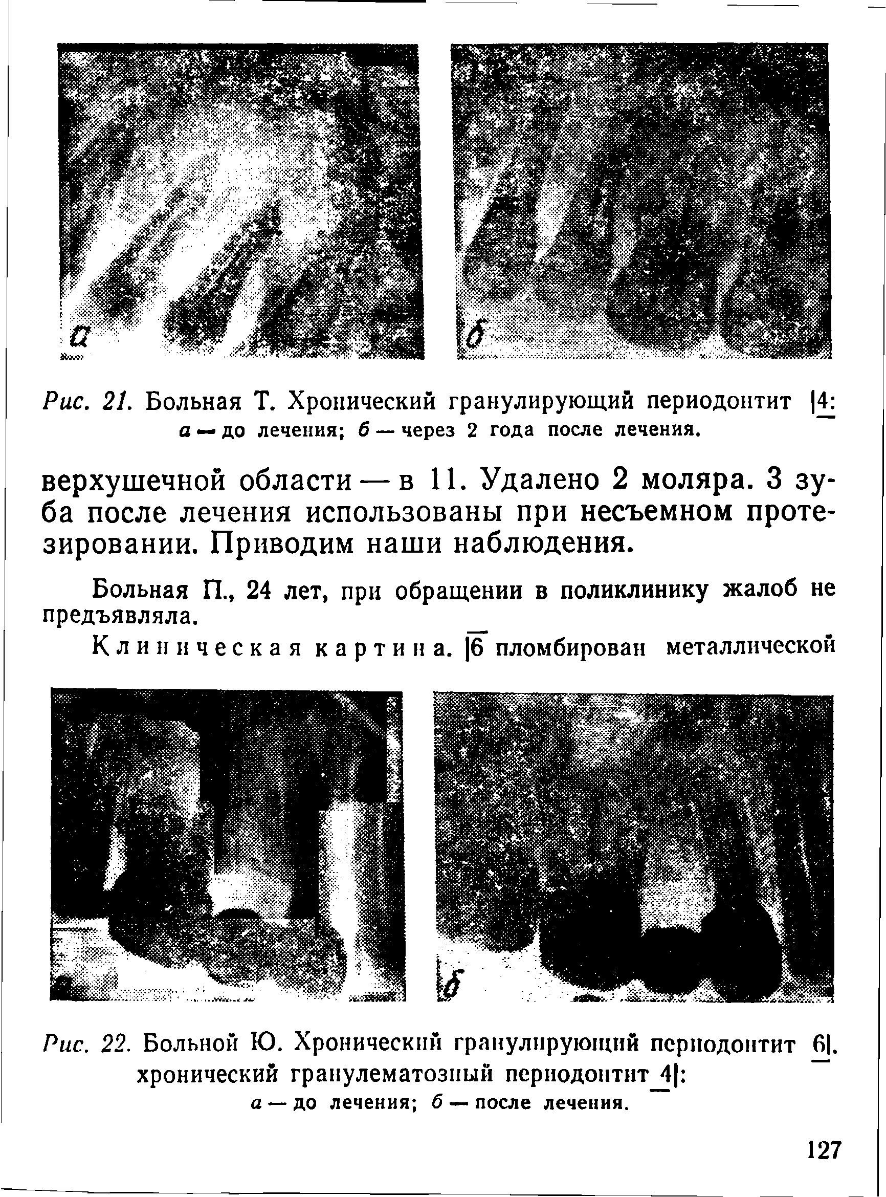 Рис. 22. Больной Ю. Хронический гранулирующий периодонтит 6. хронический гранулематозный периодонтит 4 а—до лечения б — после лечения.