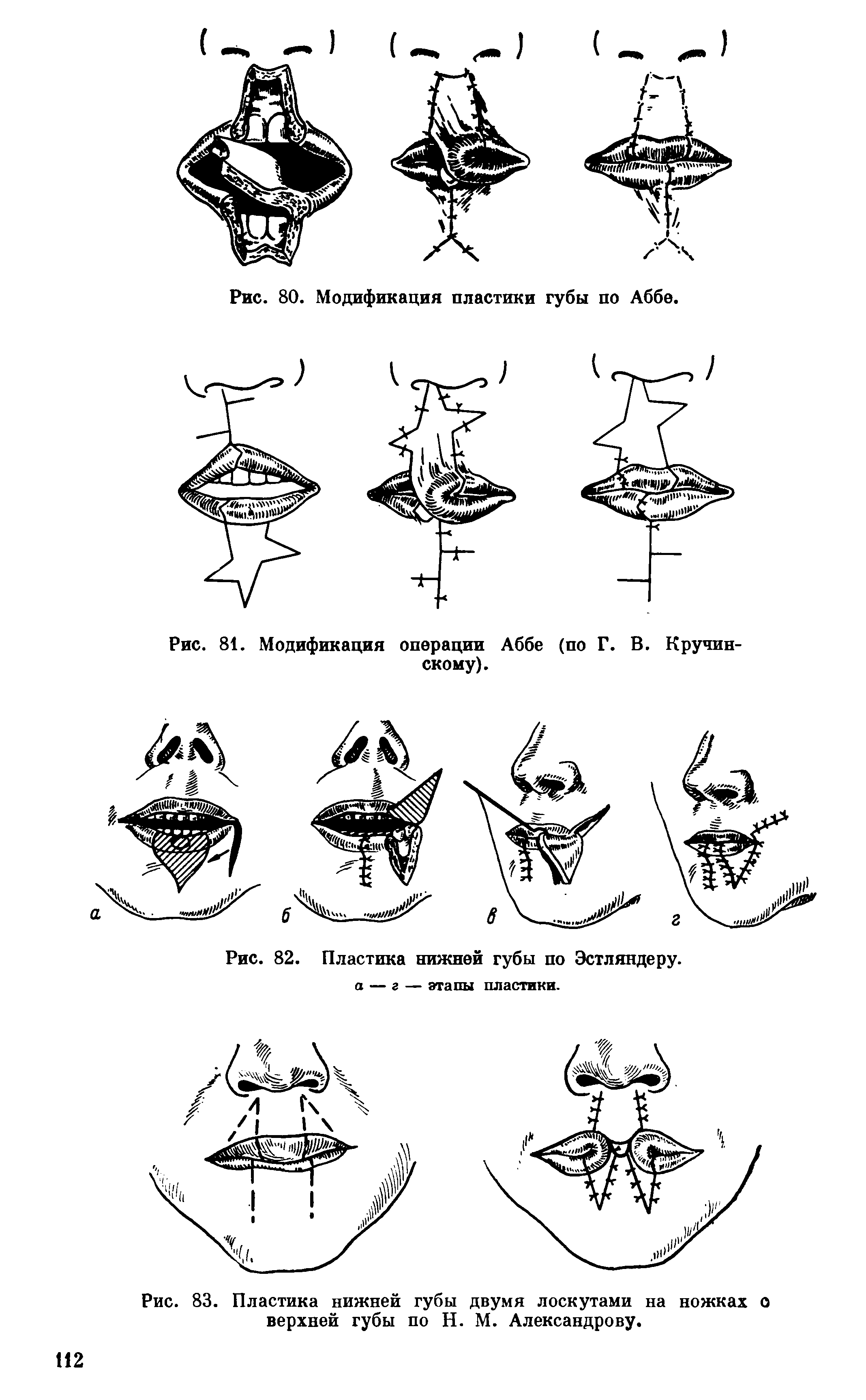 Рис. 83. Пластика нижней губы двумя лоскутами на ножках о верхней губы по Н. М. Александрову.