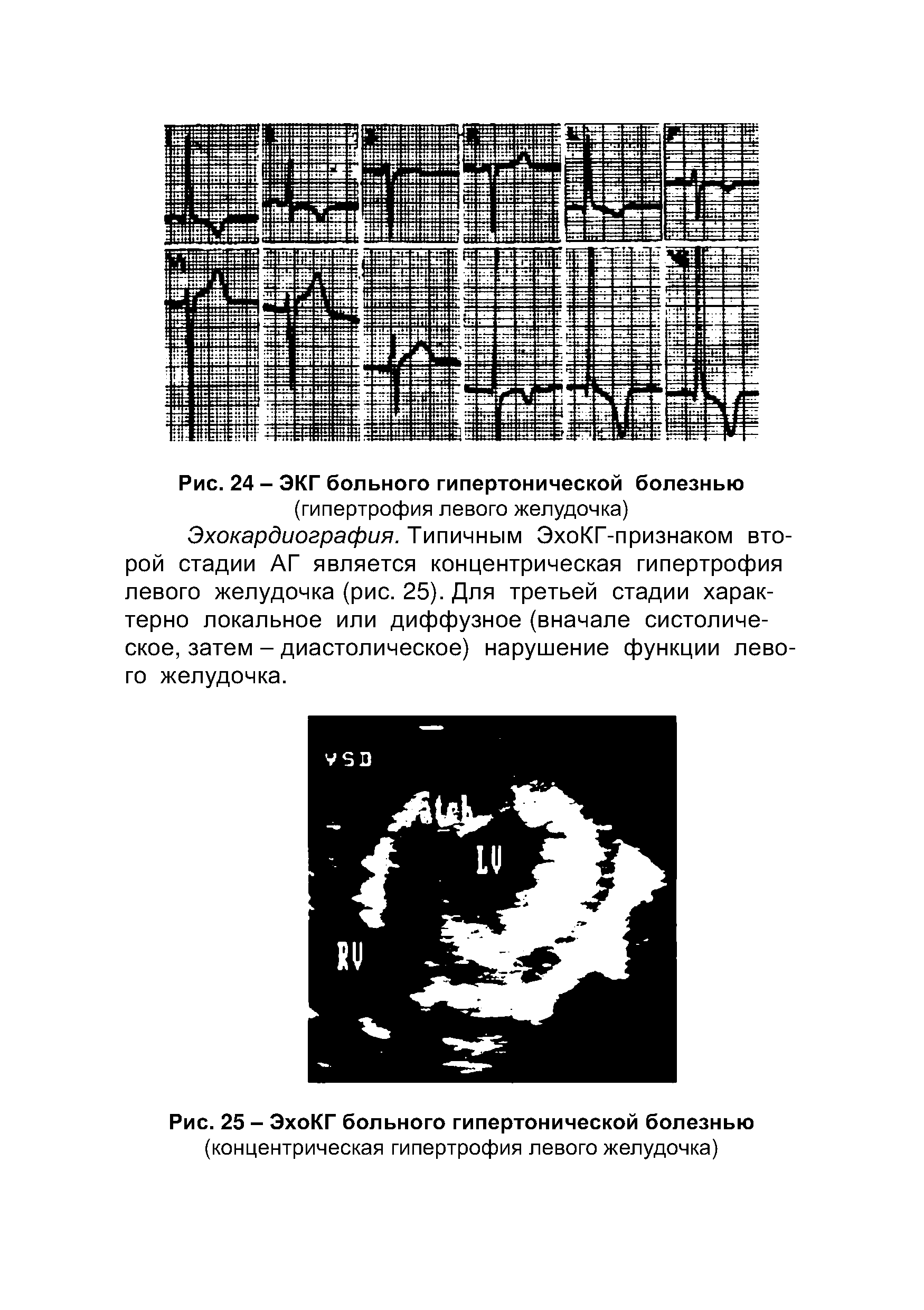 Рис. 25 - ЭхоКГ больного гипертонической болезнью (концентрическая гипертрофия левого желудочка)...