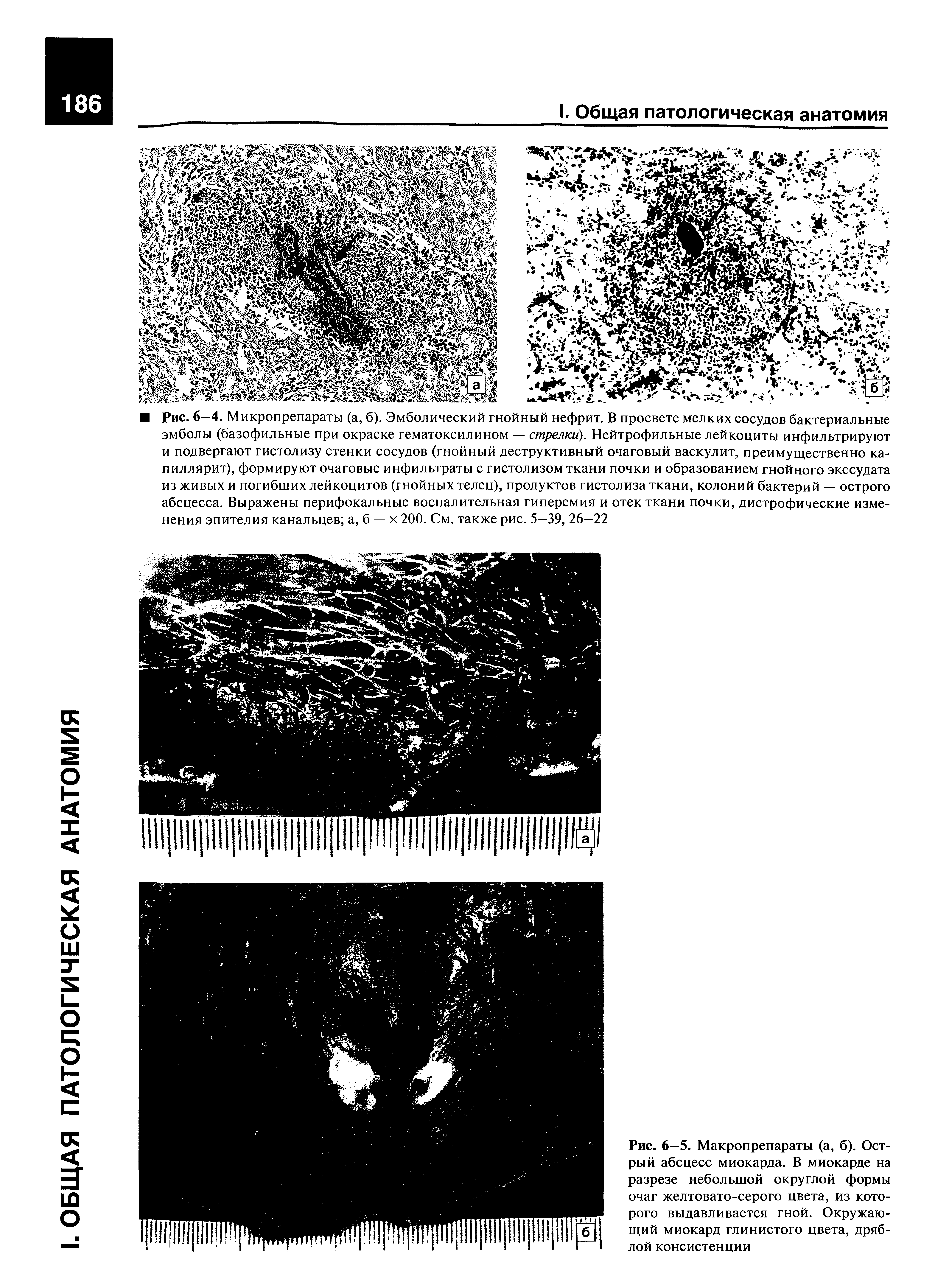 Рис. 6—5. Макропрепараты (а, б). Острый абсцесс миокарда. В миокарде на разрезе небольшой округлой формы очаг желтовато-серого цвета, из которого выдавливается гной. Окружающий миокард глинистого цвета, дряблой консистенции...