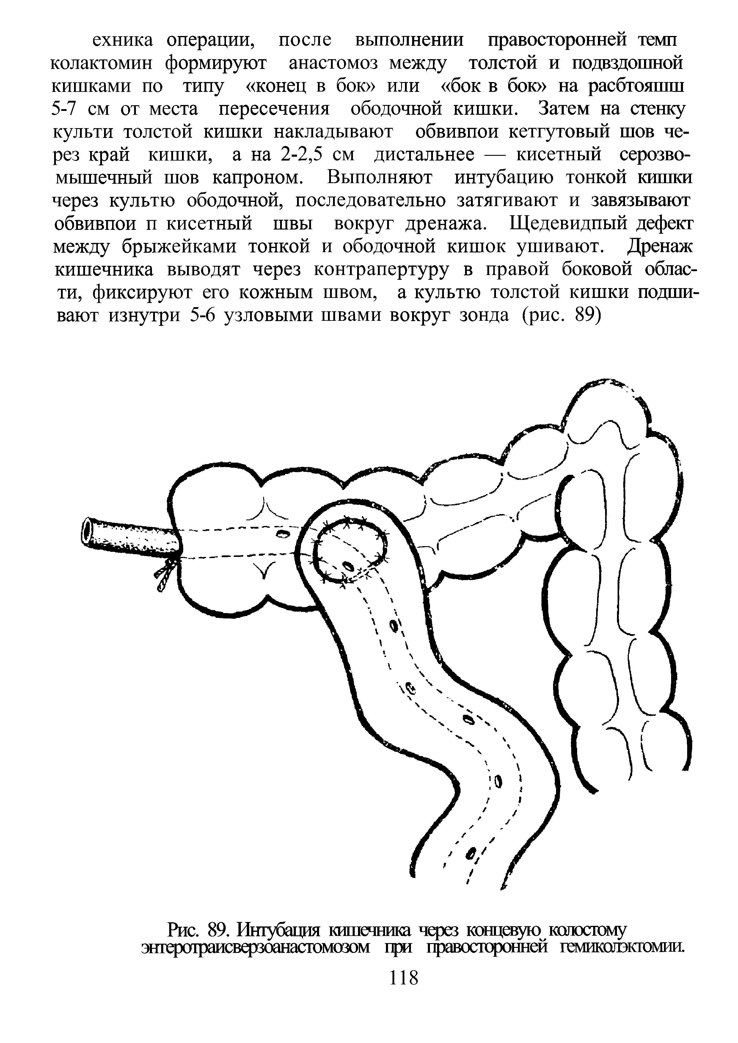 Рис. 89. Интубация кишечника через концевую колостому энтеротраисверзоанастомозом при правосторонней гемиколэкгомии.