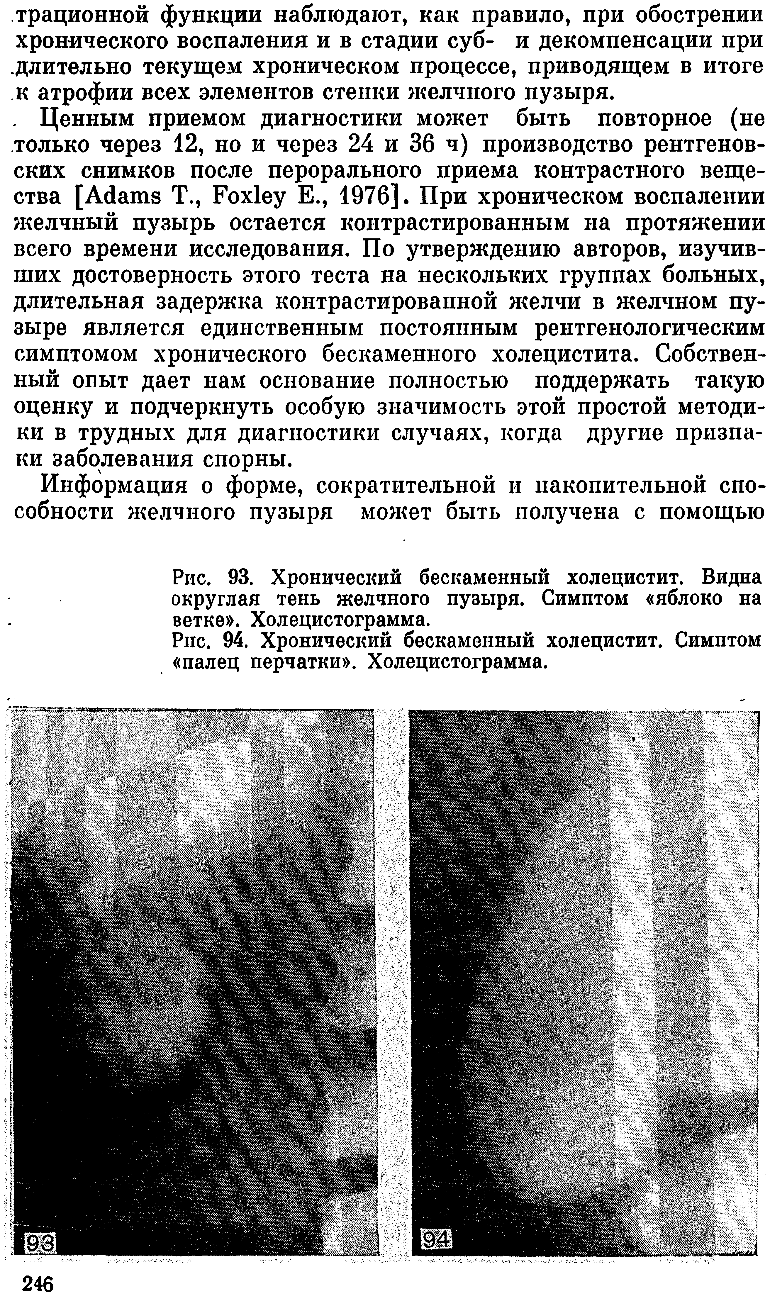 Рис. 93. Хронический бескаменный холецистит. Видна округлая тень желчного пузыря. Симптом яблоко на ветке . Холецистограмма.