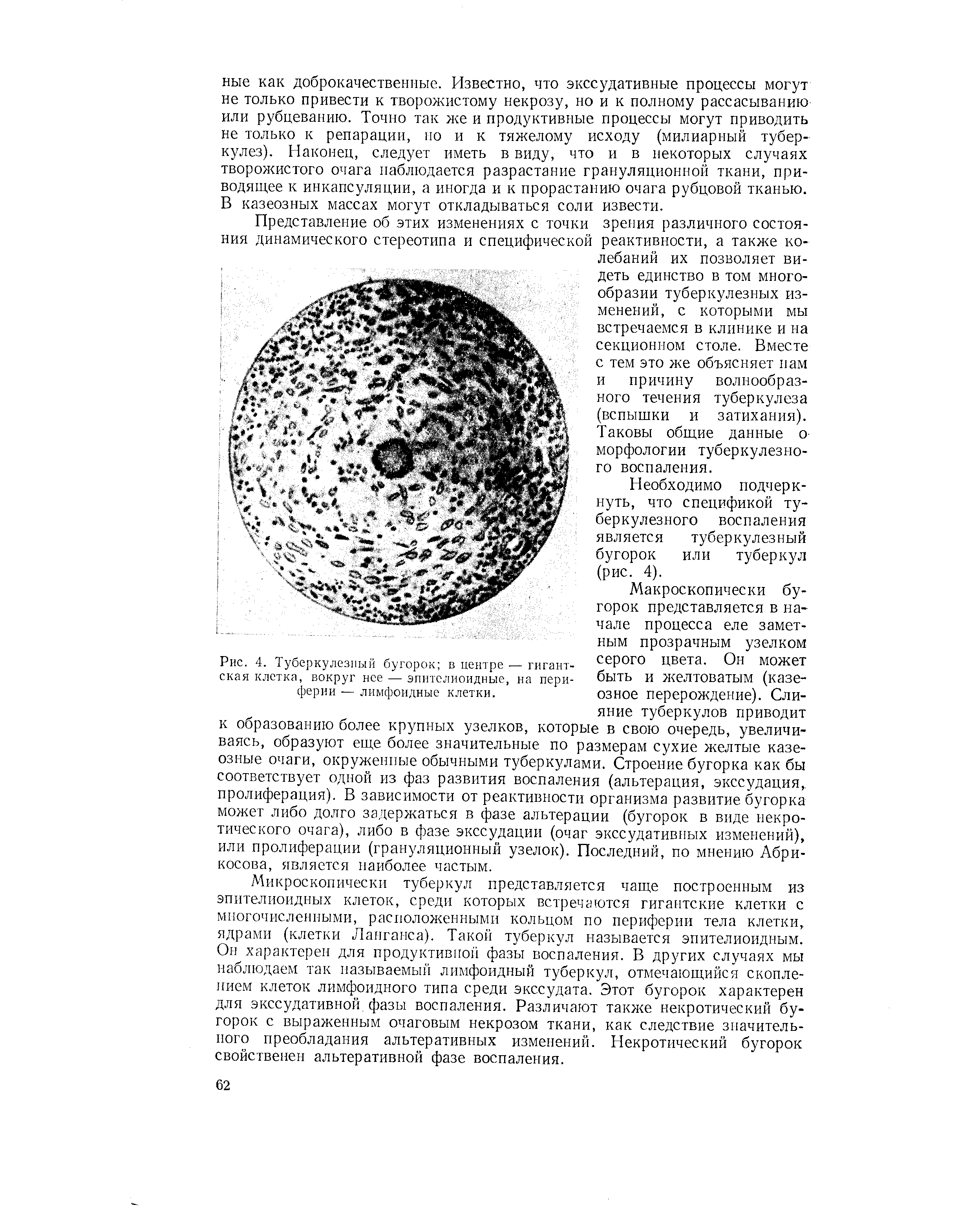 Рис. 4. Туберкулезный бугорок в центре — гигантская клетка, вокруг нее — эпителиоидные, на периферии — лимфоидные клетки.