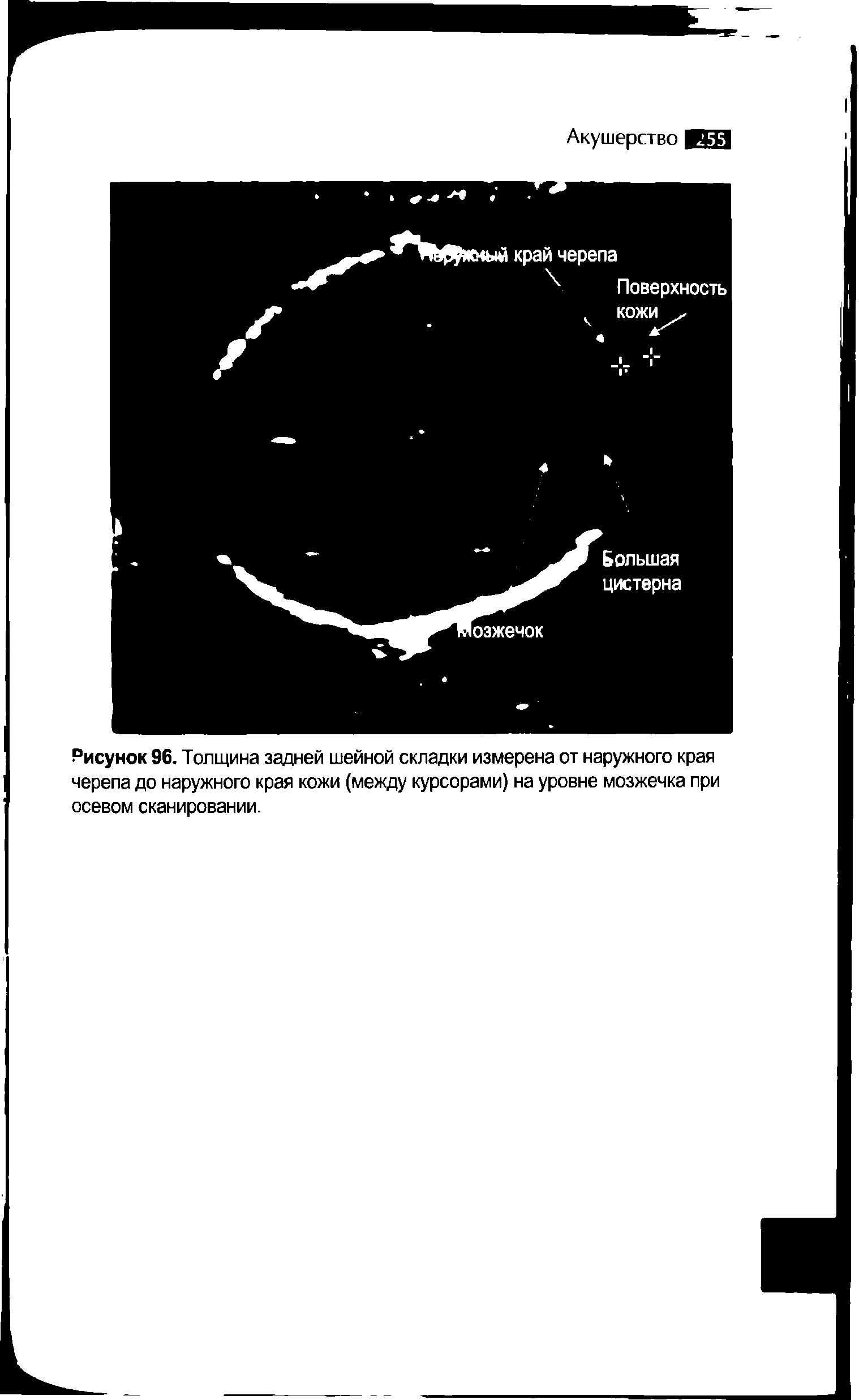 Рисунок 96. Толщина задней шейной складки измерена от наружного края черепа до наружного края кожи (между курсорами) на уровне мозжечка при осевом сканировании.