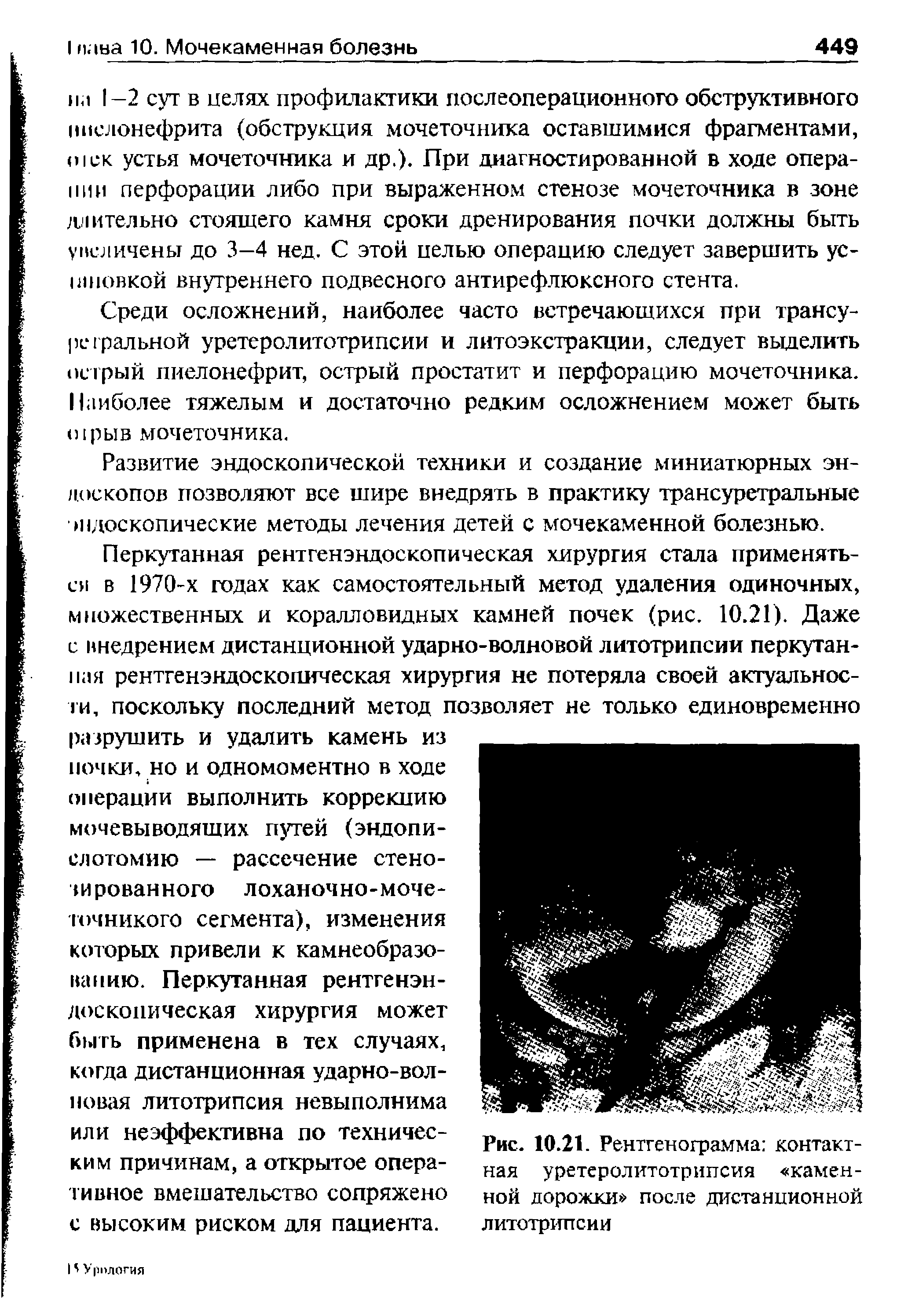 Рис. 10.21. Рентгенограмма контактная уретеролитотрипсия каменной дорожки после дистанционной литотрипсии...