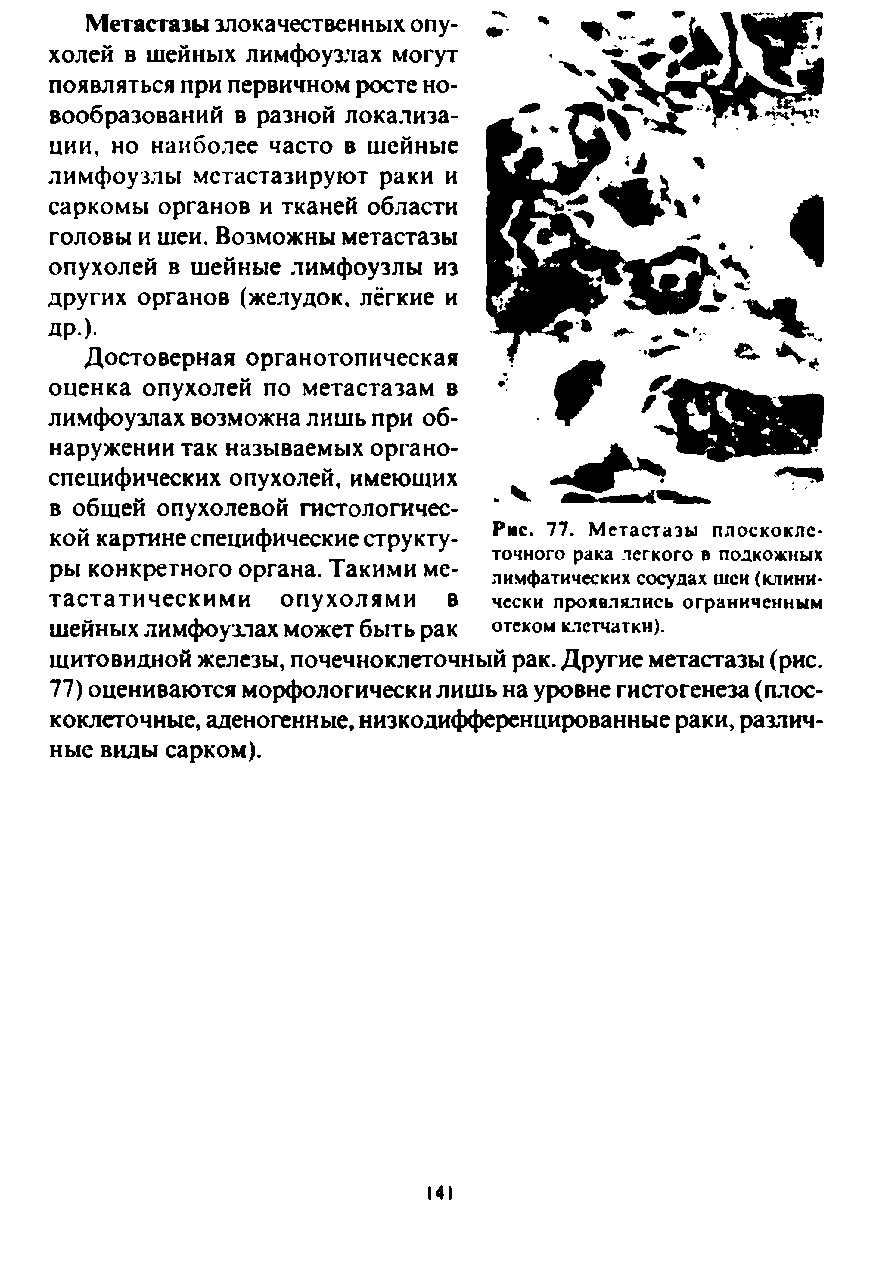 Рис. 77. Метастазы плоскоклеточного рака легкого в подкожных лимфатических сосудах шеи (клинически проявлялись ограниченным отеком клетчатки).