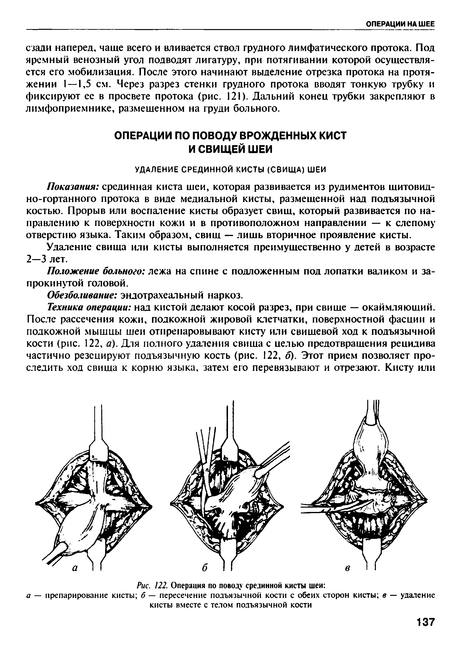 Рис. 122. Операция по поводу срединной кисты шеи а — препарирование кисты о — пересечение подъязычной кости с обеих сторон кисты в — удаление кисты вместе с телом подъязычной кости...