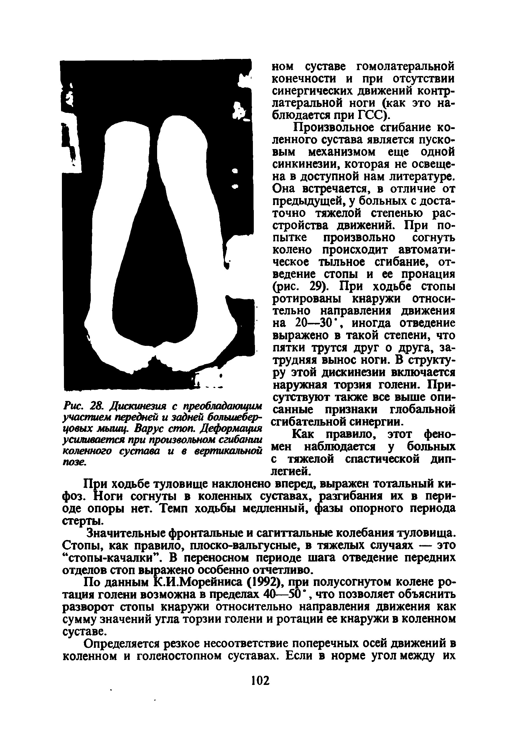 Рис. 28. Дискинезия с преобладающим участием передней и задней большеберцовых мышц. Варус стоп. Деформация усиливается при произвольном сгибании коленного сустава и в вертикальной позе.