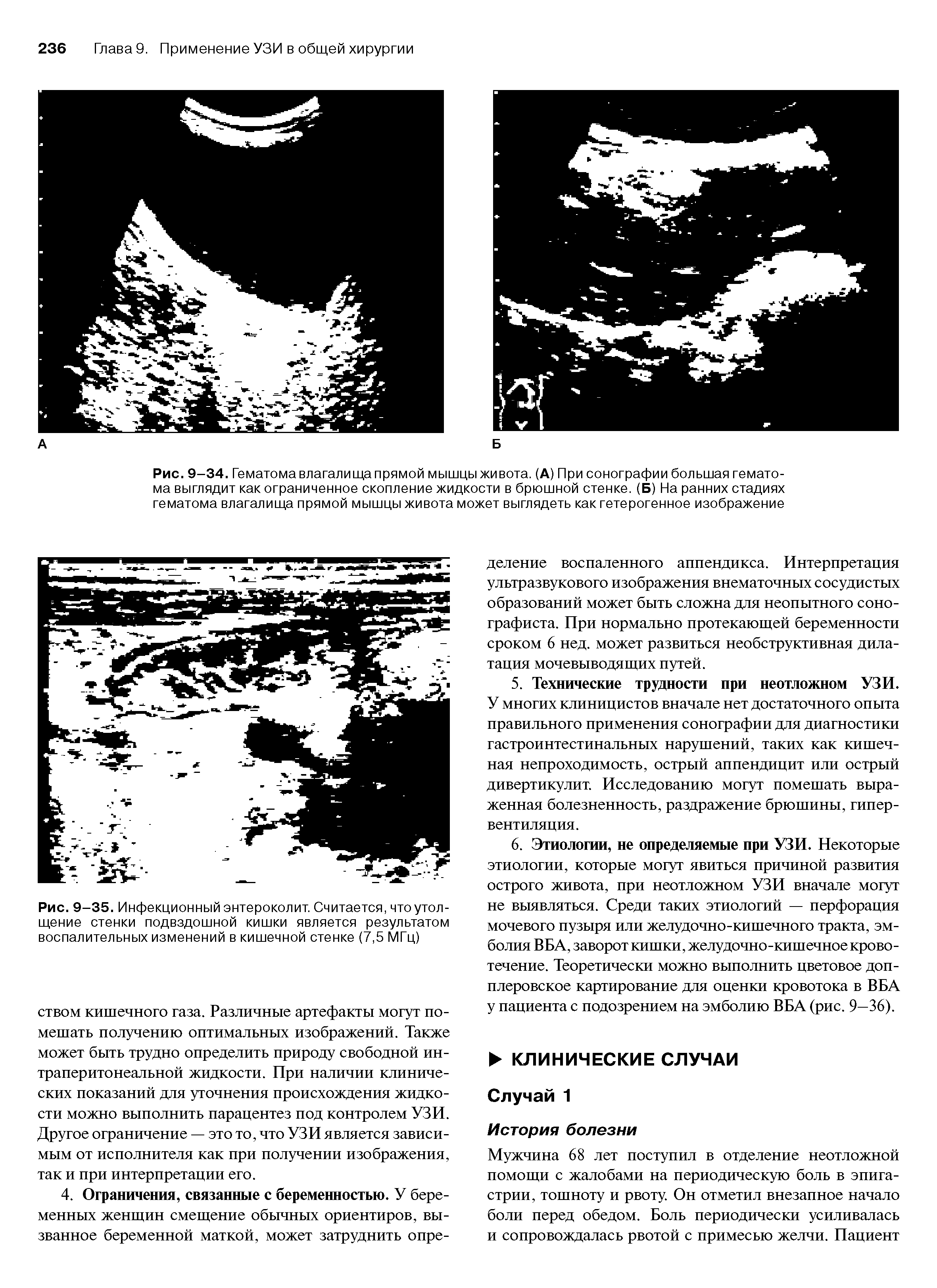 Рис. 9-34. Гематома влагалища прямой мышцы живота. (А) При сонографии большая гематома выглядит как ограниченное скопление жидкости в брюшной стенке. (Б) На ранних стадиях гематома влагалища прямой мышцы живота может выглядеть как гетерогенное изображение...