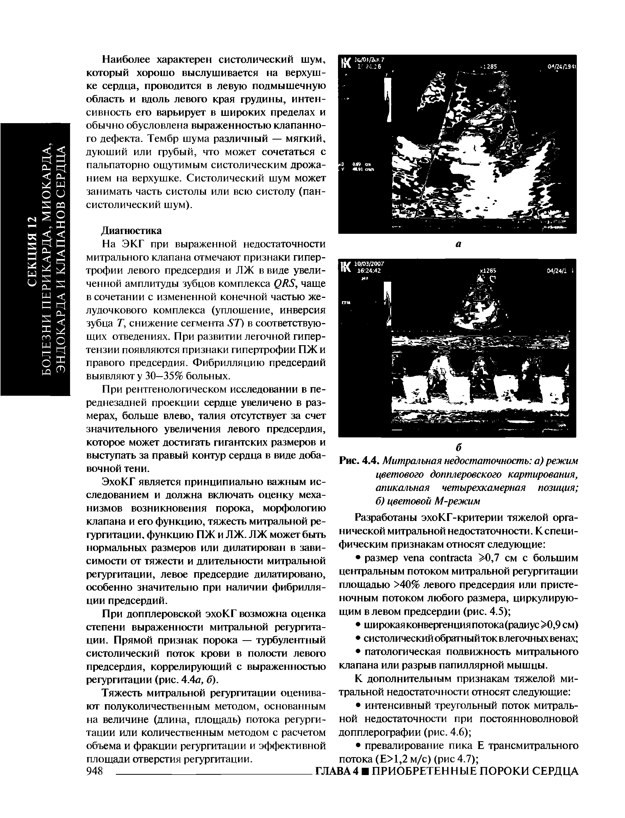 Рис. 4.4. Митральная недостаточность а) режим цветового допплеровского картирования, апикальная четырехкамерная позиция б) цветовой М-режим...