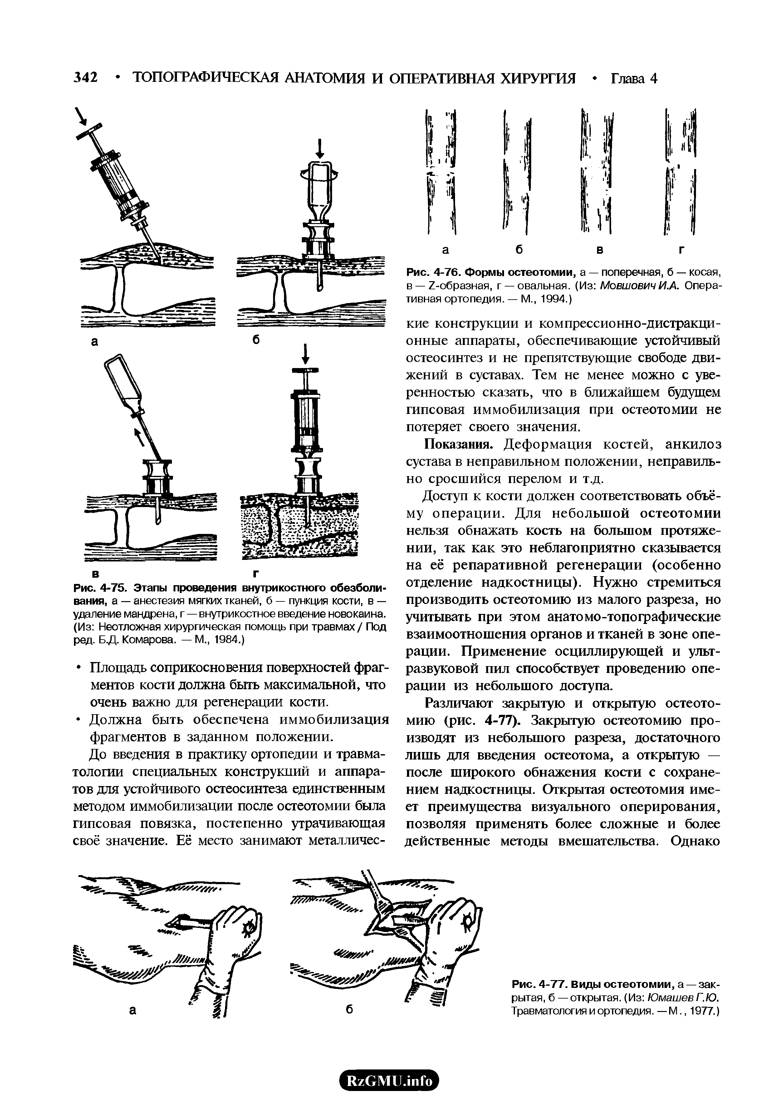 Рис. 4-75. Этапы проведения внутрикостного обезболивания, а — анестезия мягких тканей, б — пункция кости, в — удаление мандрена, г — внутрикостное введение новокаина. (Из Неотложная хирургическая помощь при травмах / Под ред. Б.Д. Комарова. — М., 1984.)...