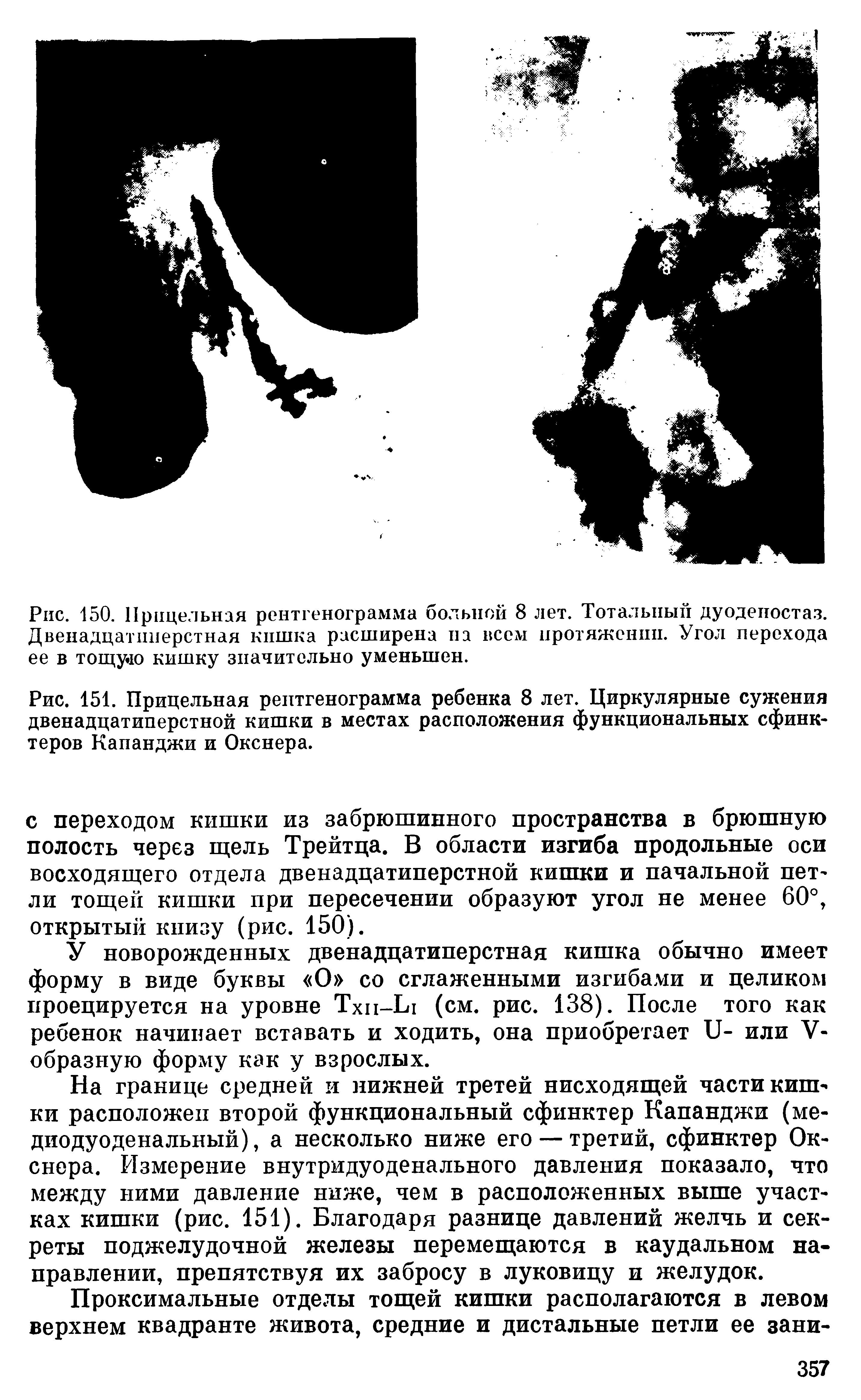 Рис. 151. Прицельная рентгенограмма ребенка 8 лет. Циркулярные сужения двенадцатиперстной кишки в местах расположения функциональных сфинктеров Капанджи и Окснера.