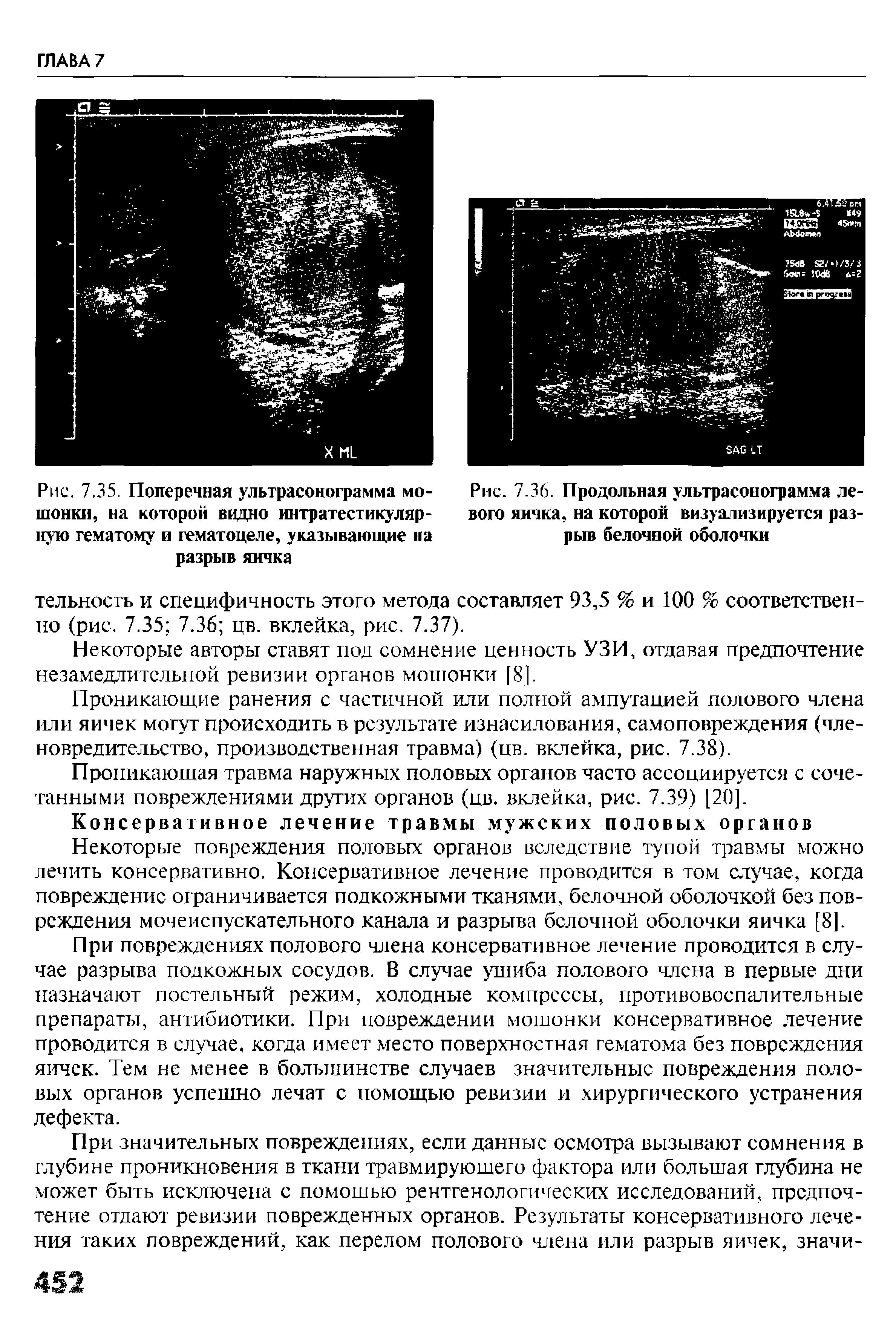 Рис. 7.35. Поперечная ультрасонограмма мошонки, на которой видно интратестикуляр-ную гематому и гематоцеле, указывающие на...