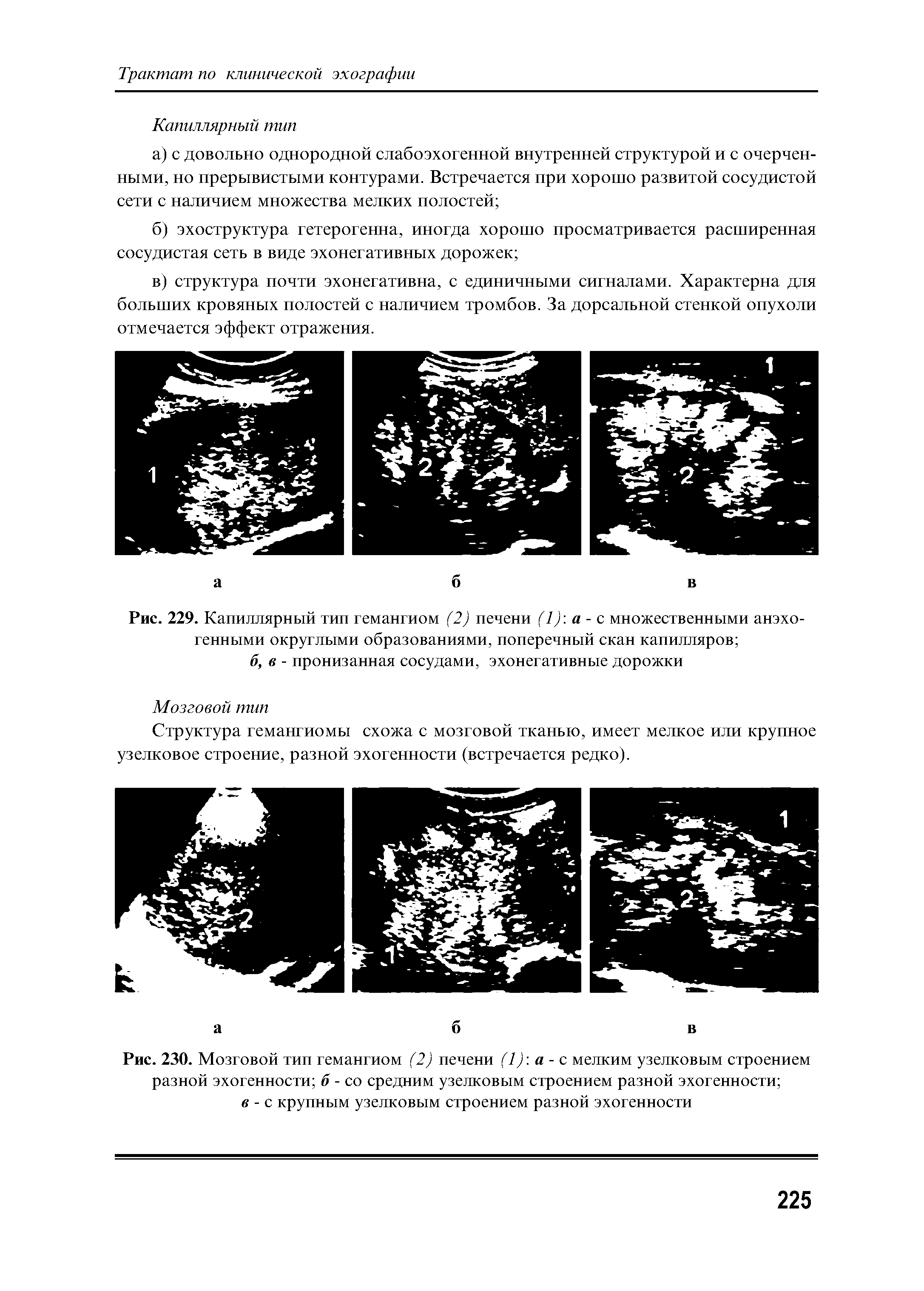 Рис. 230. Мозговой тип гемангиом (2) печени (1) а - с мелким узелковым строением разной эхогенности б - со средним узелковым строением разной эхогенности в - с крупным узелковым строением разной эхогенности...