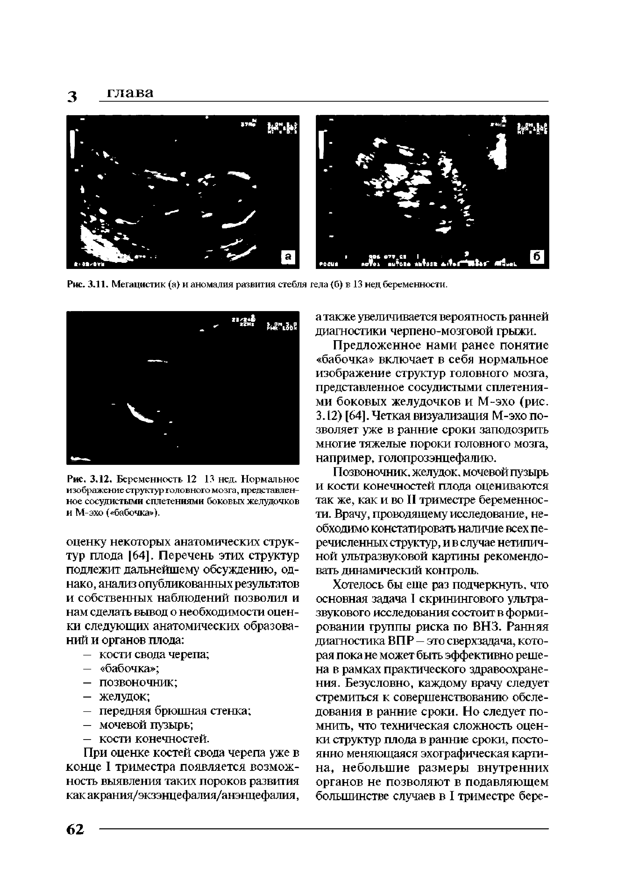 Рис. 3.11. Мегацистик (а) и аномалия развития стебля тела (б) в 13 нед беременности.